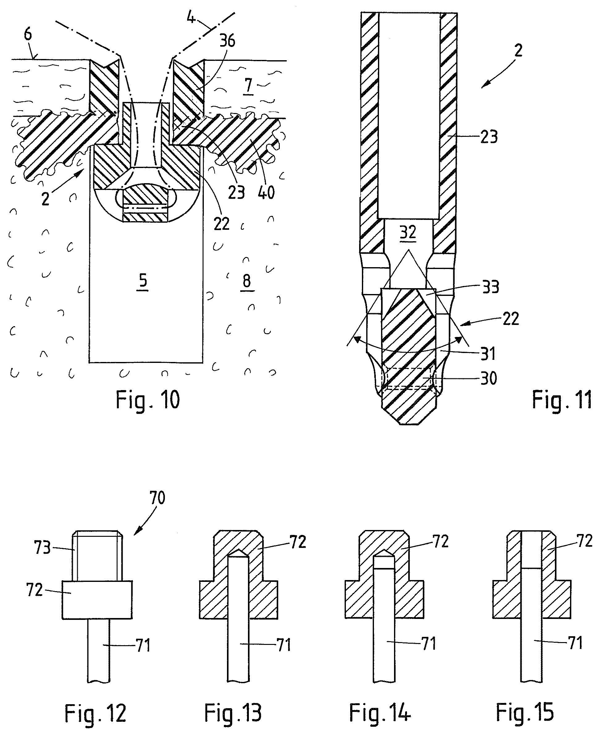Patent US12569242 Figure 7 – Device and method for fixating a suture anchor in hard tissue