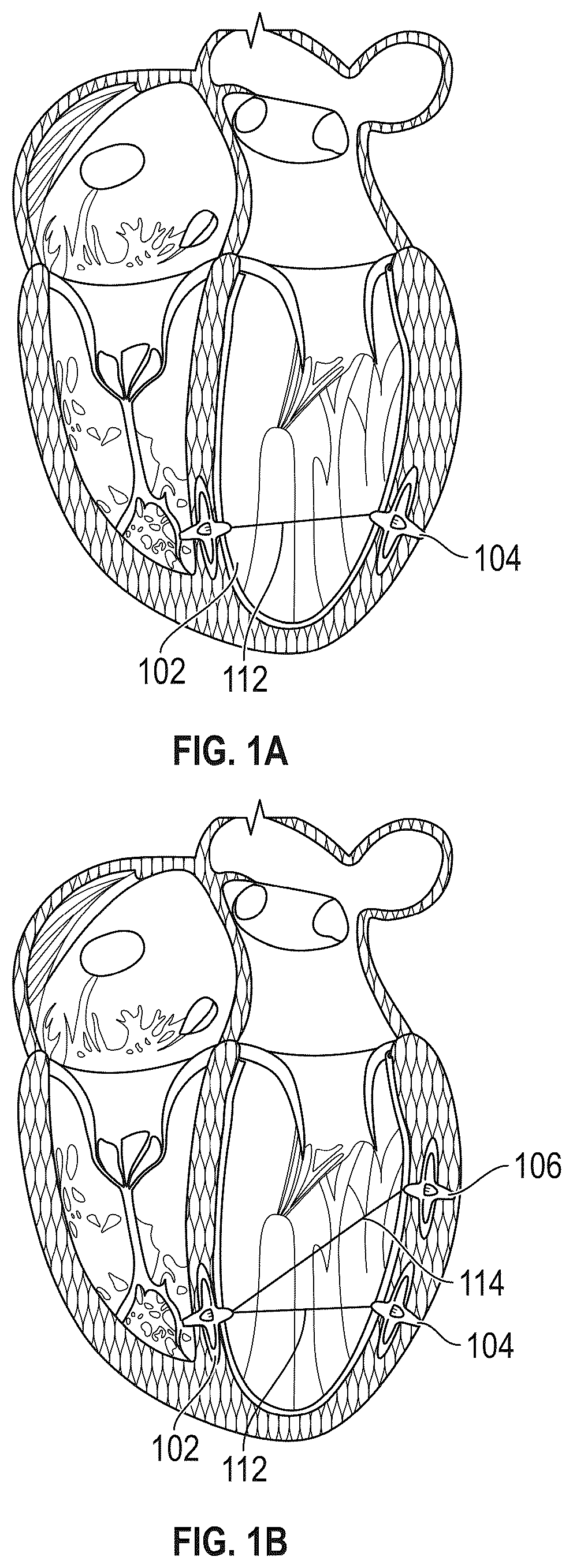 Patent US12569243 Figure 1 – Systems for percutaneous ventriculoplasty using ventricular anchors