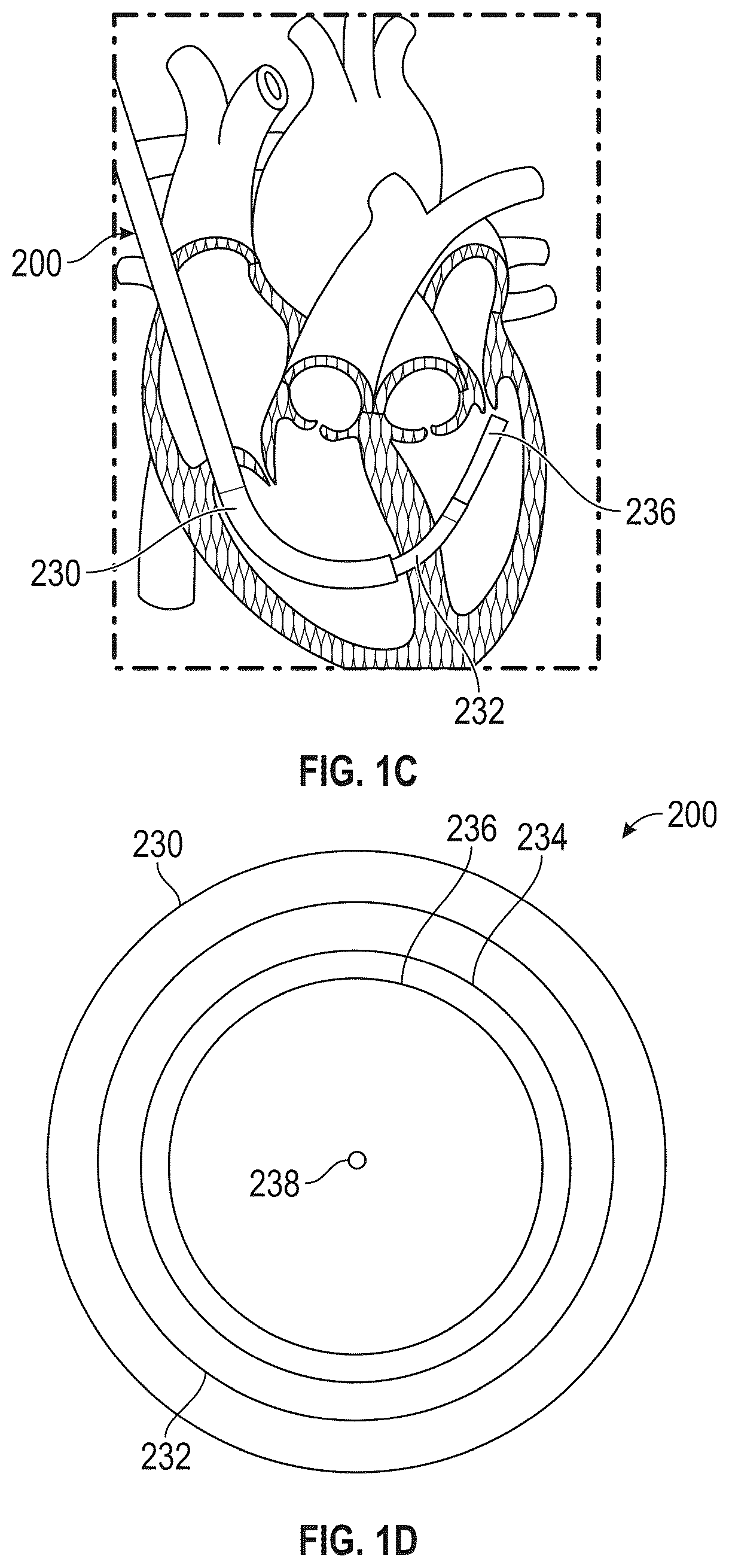 Patent US12569243 Figure 2 – Systems for percutaneous ventriculoplasty using ventricular anchors