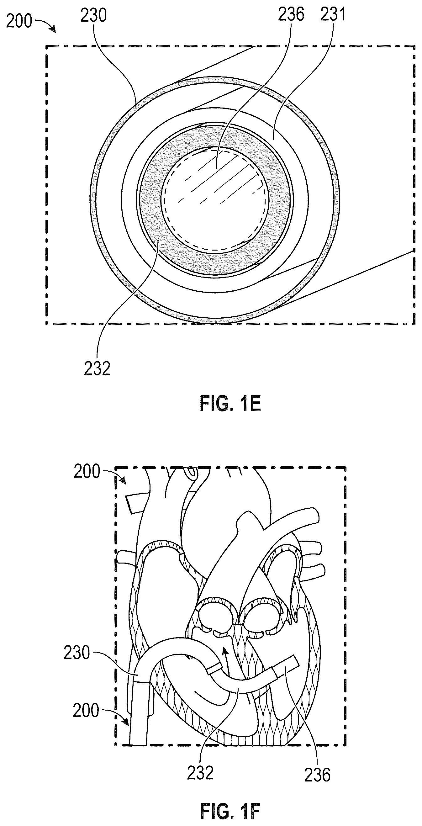 Patent US12569243 Figure 3 – Systems for percutaneous ventriculoplasty using ventricular anchors