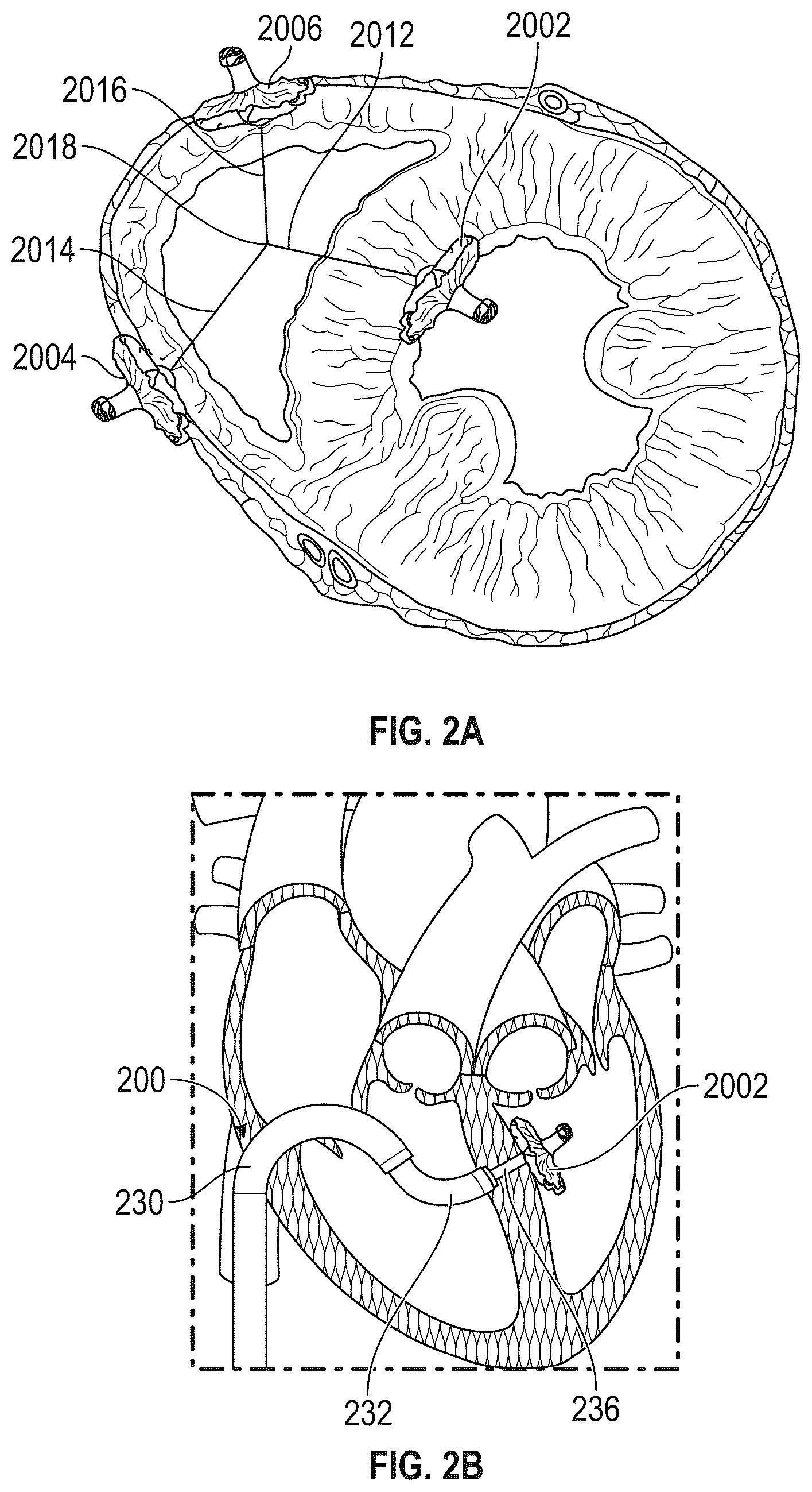 Patent US12569243 Figure 4 – Systems for percutaneous ventriculoplasty using ventricular anchors