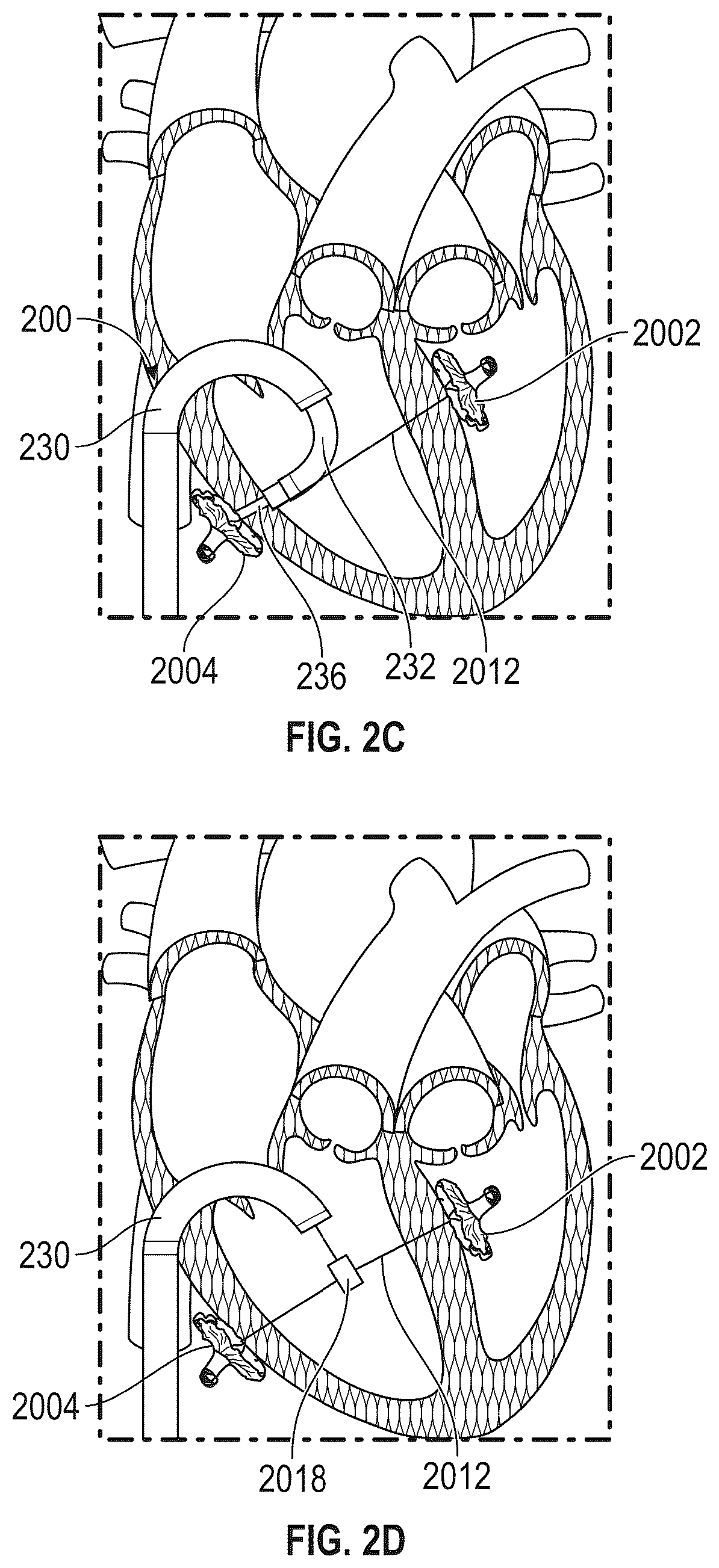 Patent US12569243 Figure 5 – Systems for percutaneous ventriculoplasty using ventricular anchors