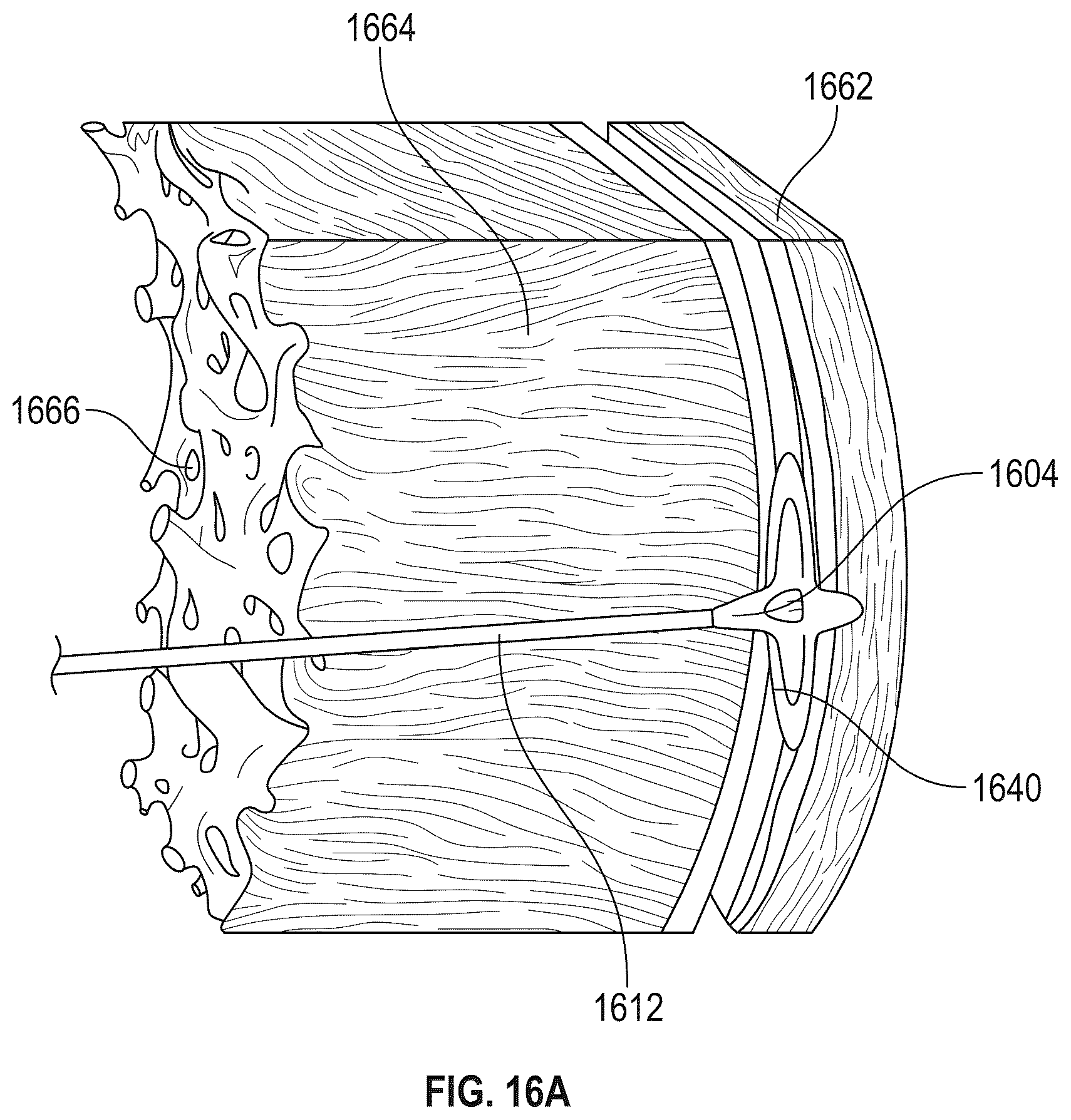 Patent US12569243 Figure 13 – Systems for percutaneous ventriculoplasty using ventricular anchors