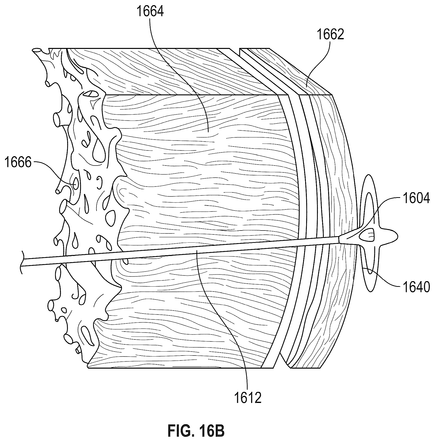 Patent US12569243 Figure 14 – Systems for percutaneous ventriculoplasty using ventricular anchors