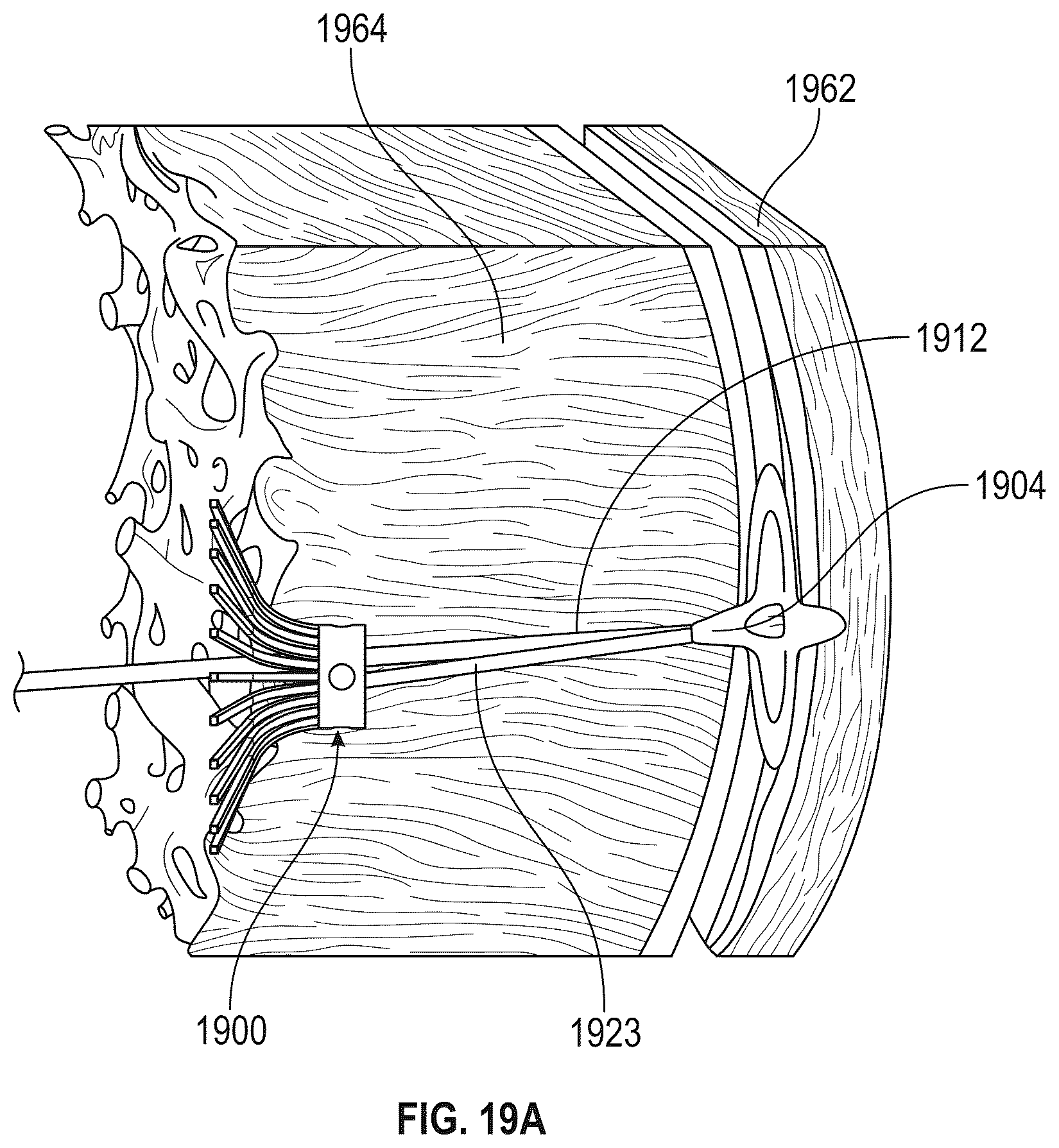 Patent US12569243 Figure 19 – Systems for percutaneous ventriculoplasty using ventricular anchors