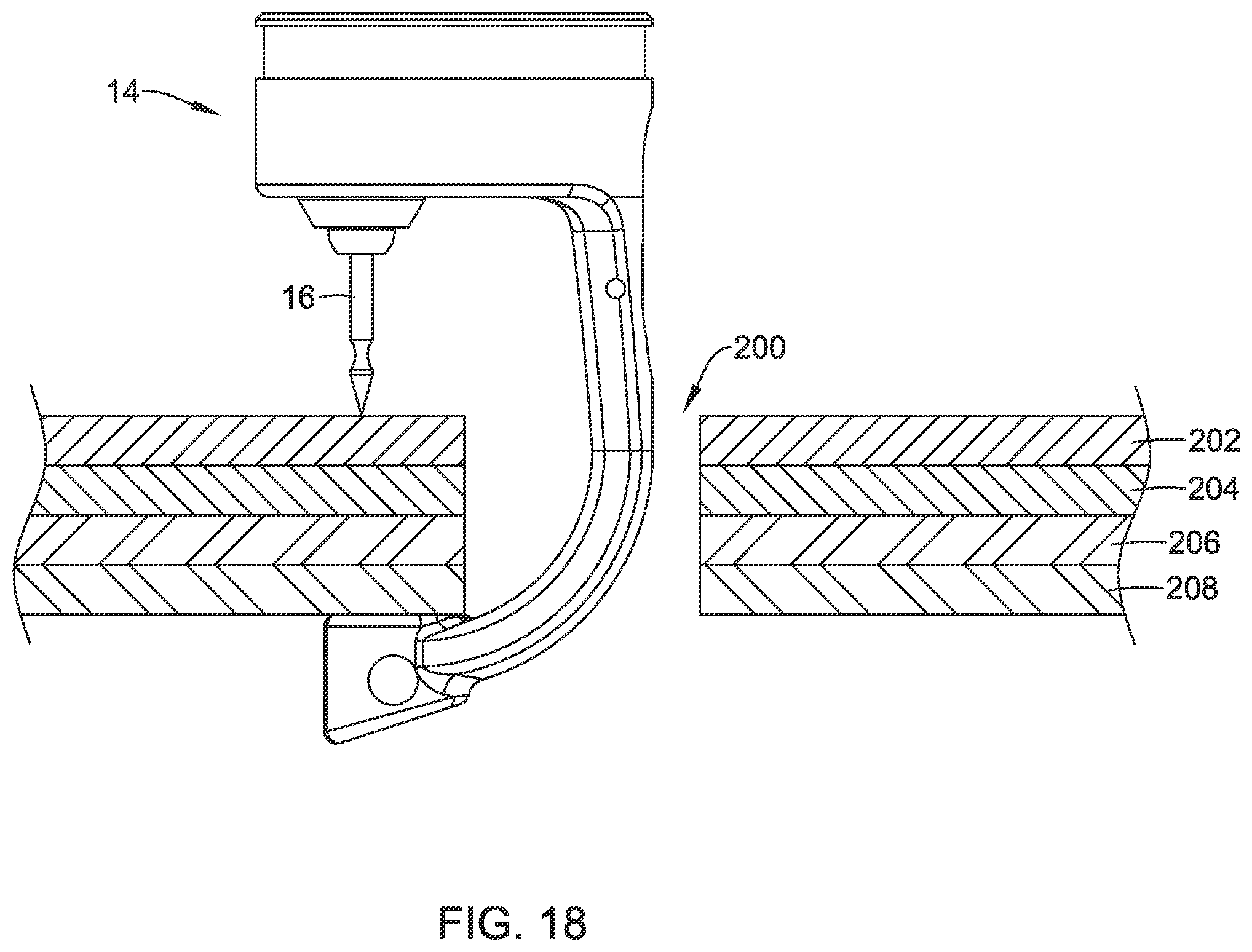 Patent US12569245 Figure 20 – Suture based closure device