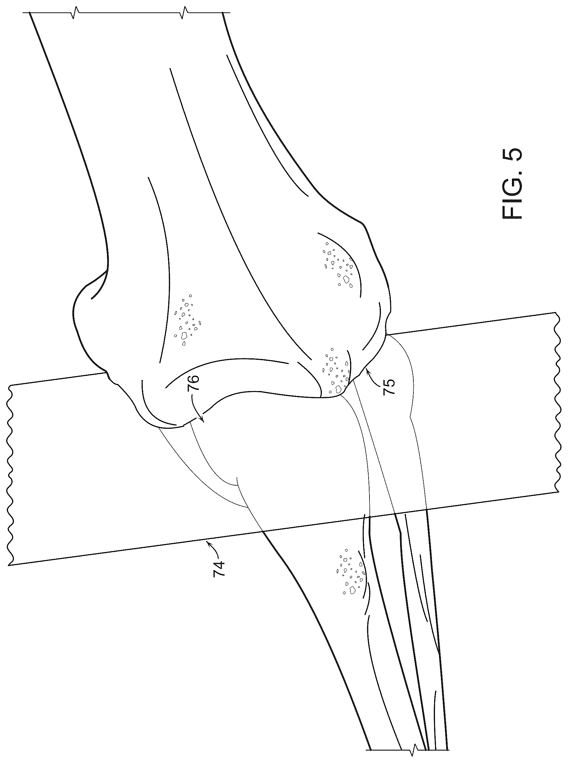 Patent US12569260 Figure 7 – Controls for power tools or instruments including bone saws and drills including safety and directional control and haptic feedback