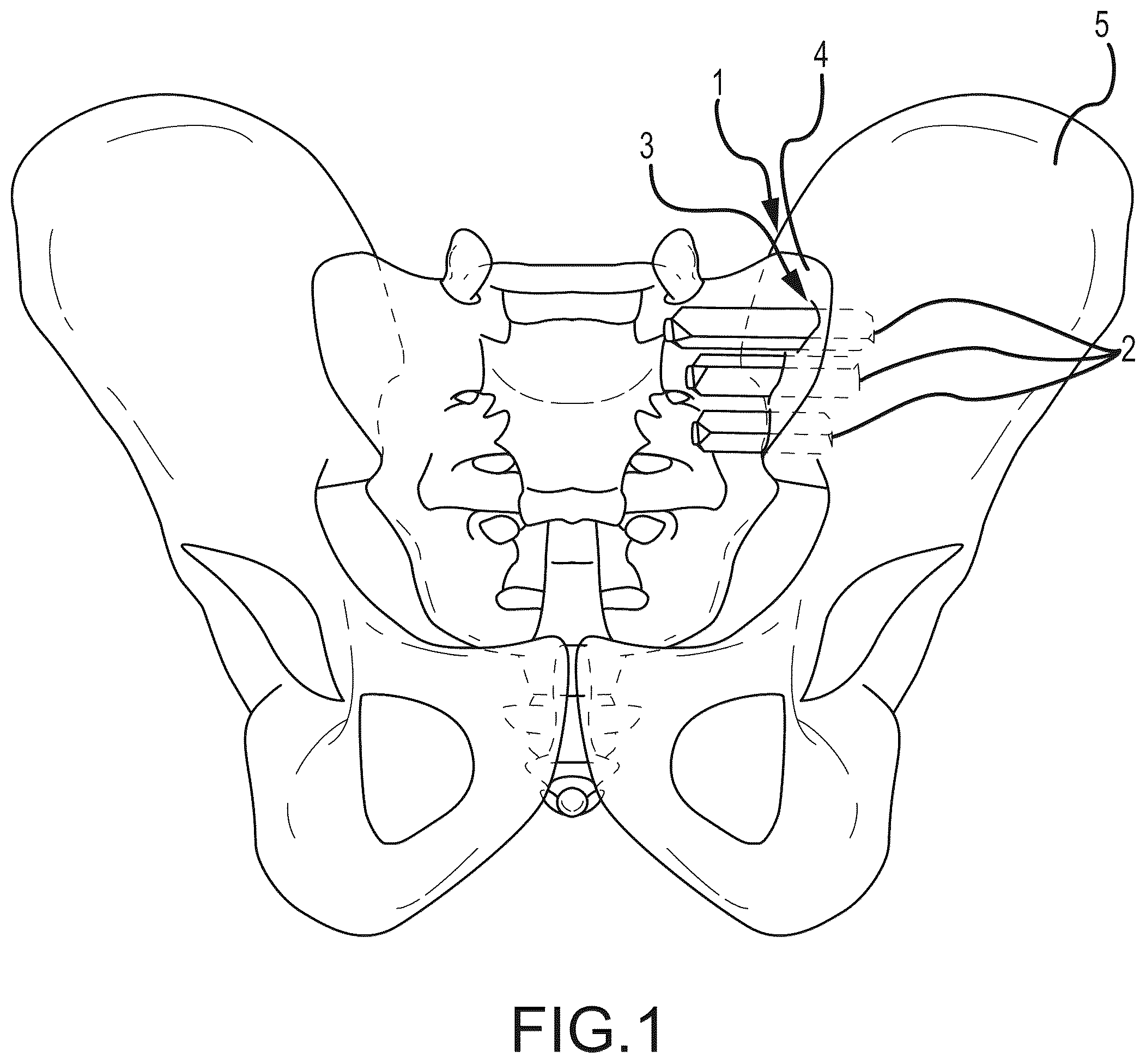 Patent US12569262 Figure 1 – Decortication instrumentation for posterior sacroiliac joint fusion