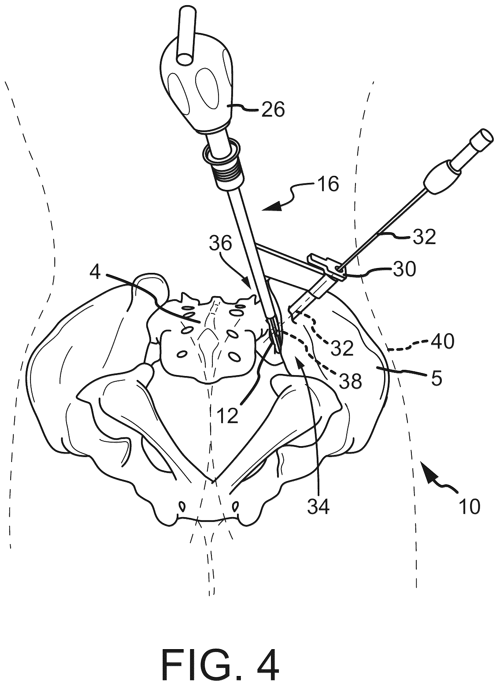 Patent US12569262 Figure 3 – Decortication instrumentation for posterior sacroiliac joint fusion