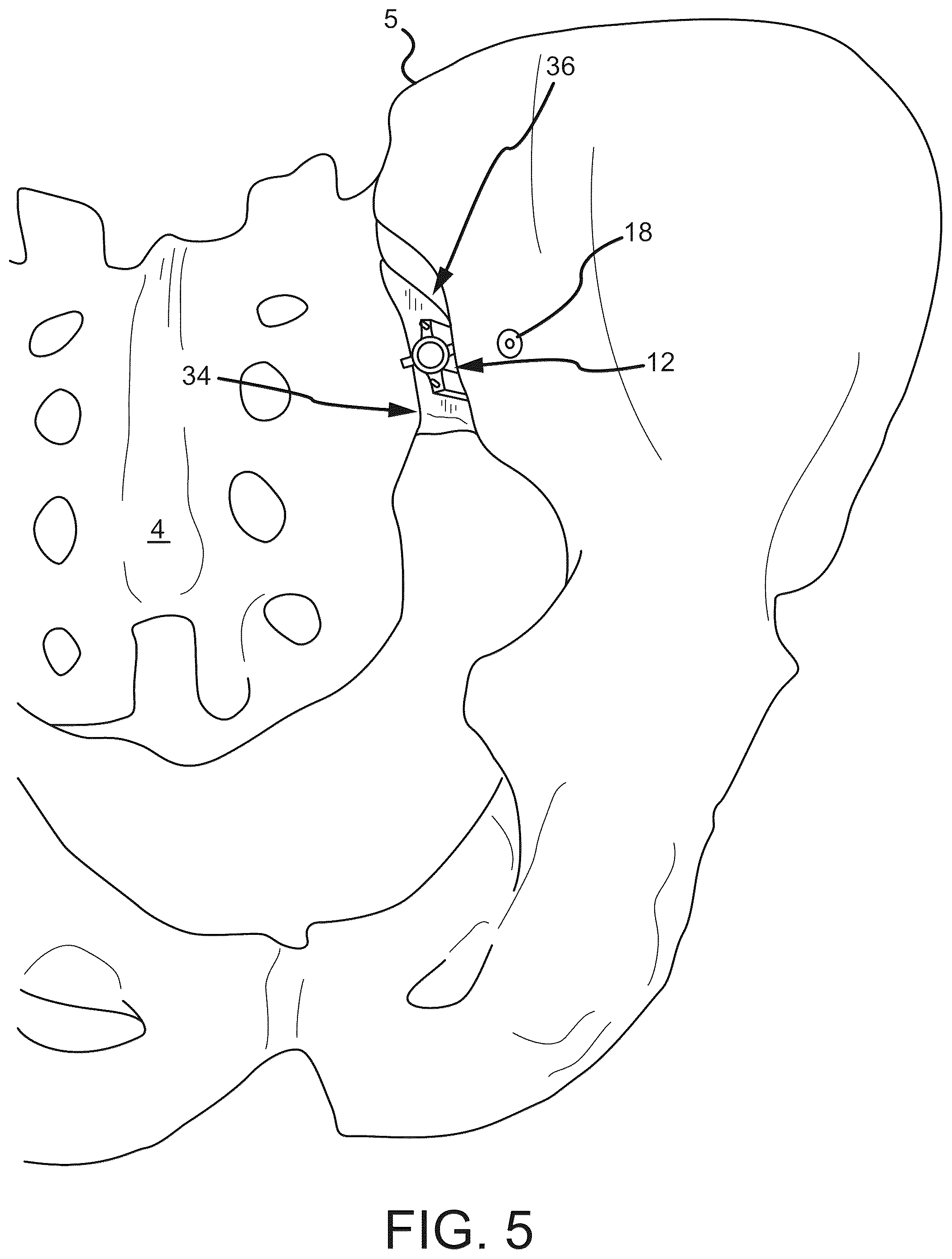 Patent US12569262 Figure 4 – Decortication instrumentation for posterior sacroiliac joint fusion