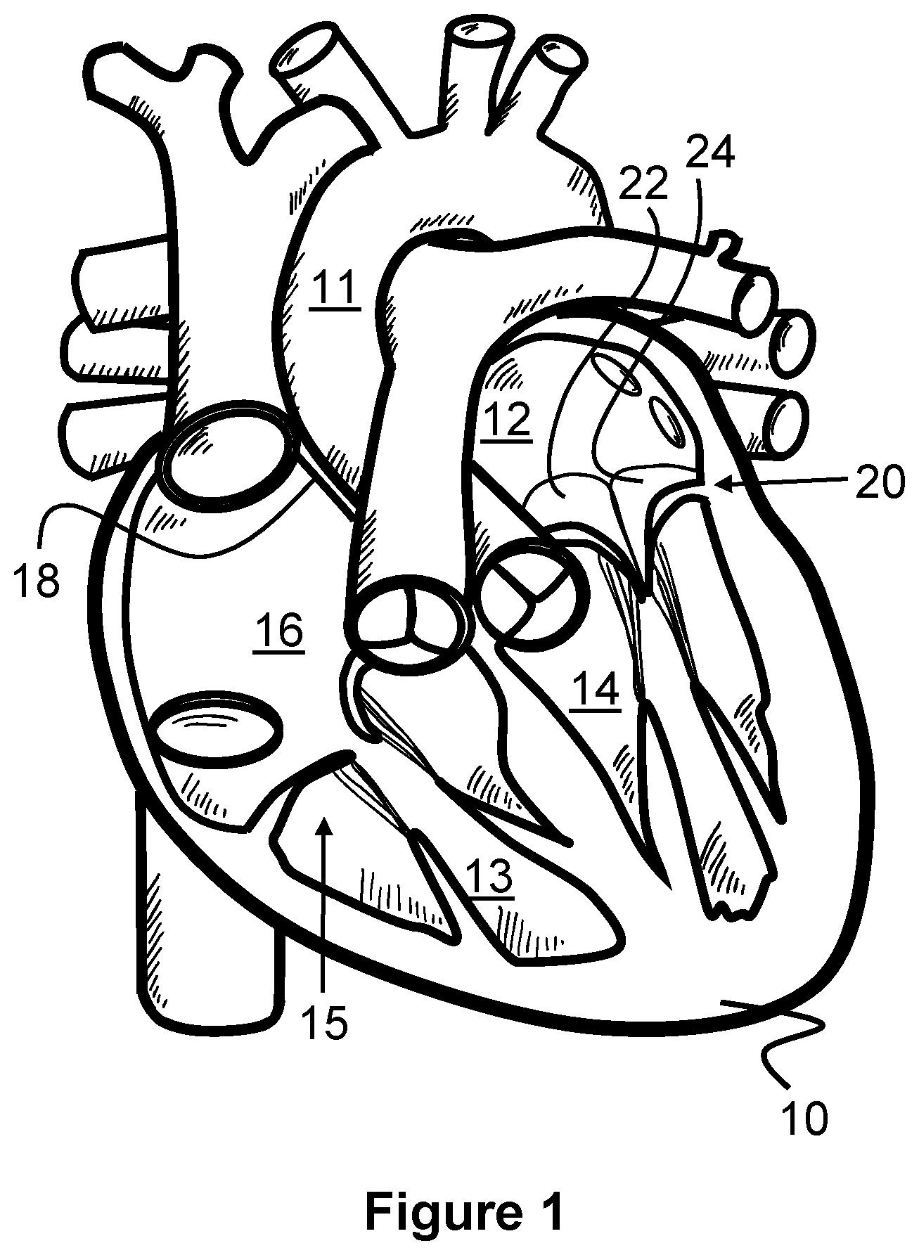 Patent US12569274 — Method and apparatus for removing heart valve therapy — Figure 1