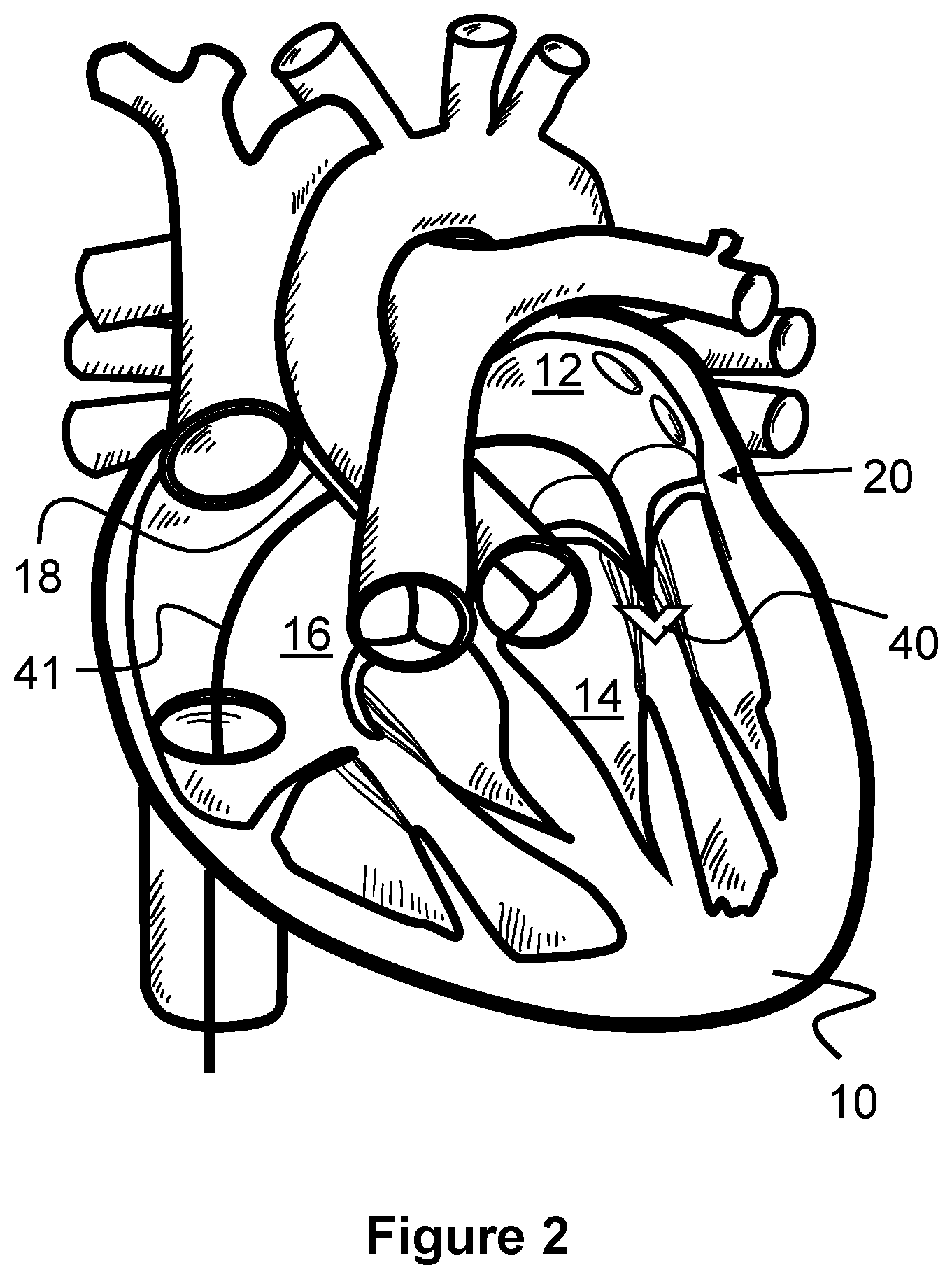 Patent US12569274 Figure 2 – Method and apparatus for removing heart valve therapy