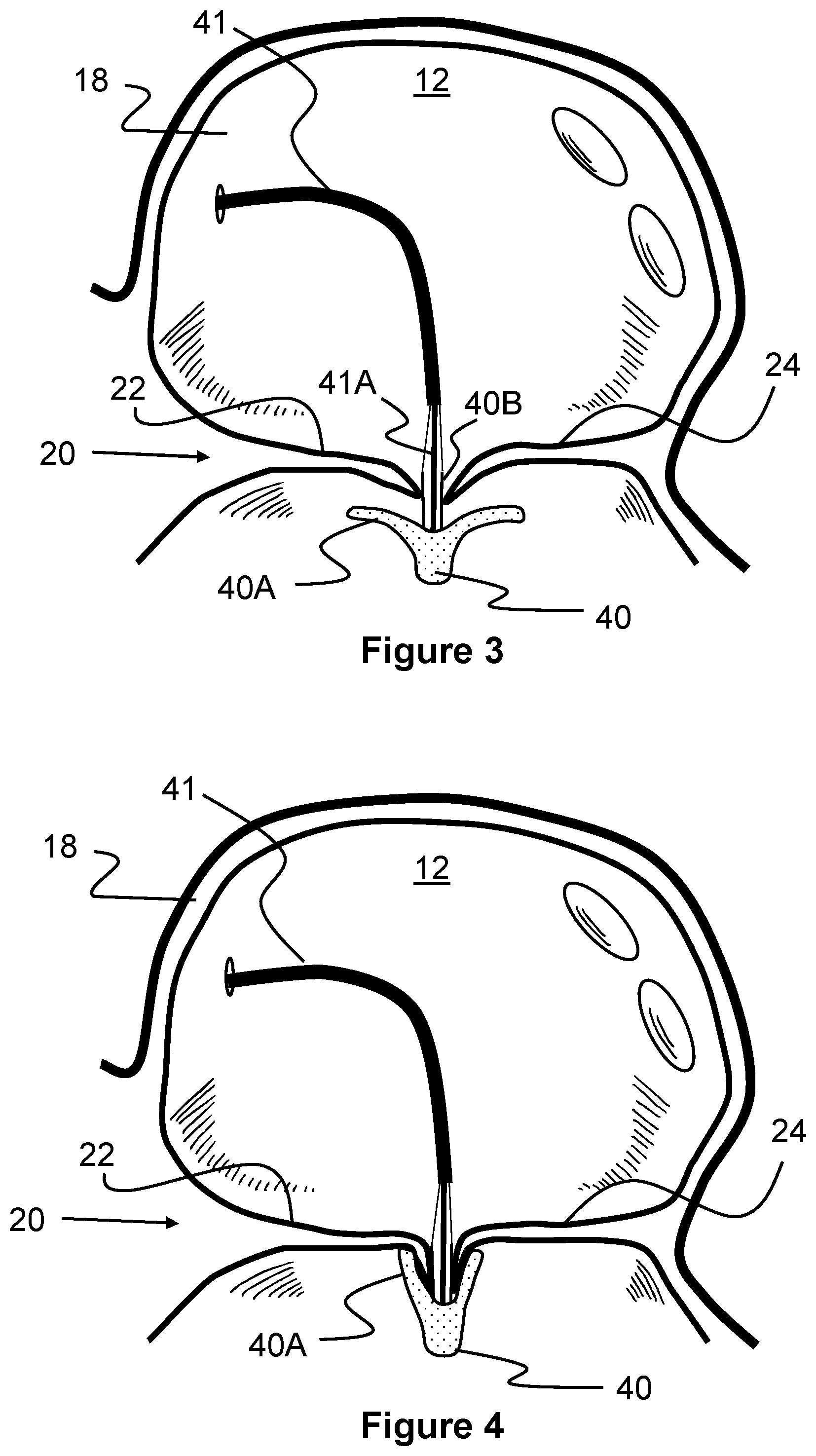 Patent US12569274 Figure 3 – Method and apparatus for removing heart valve therapy