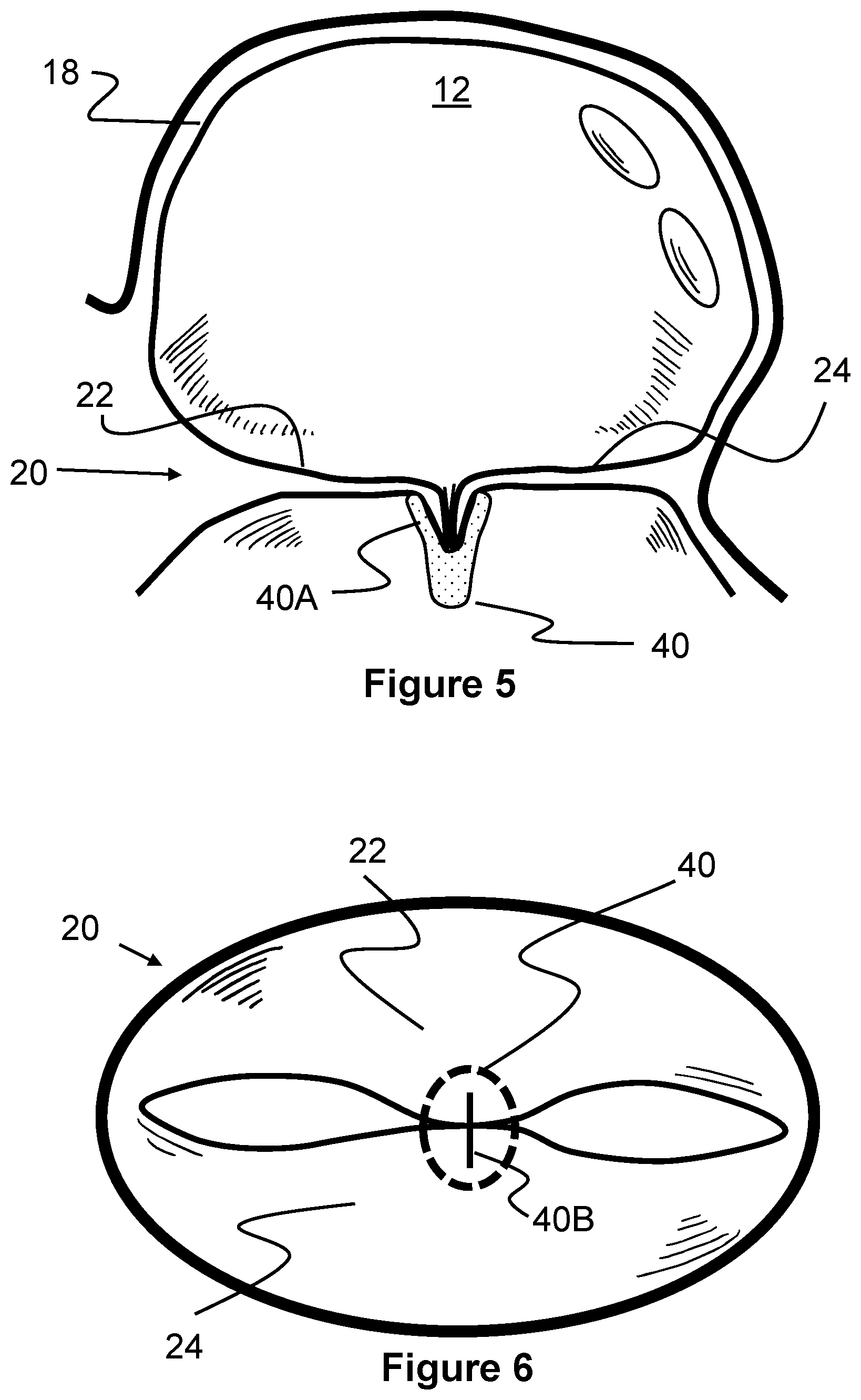 Patent US12569274 Figure 4 – Method and apparatus for removing heart valve therapy