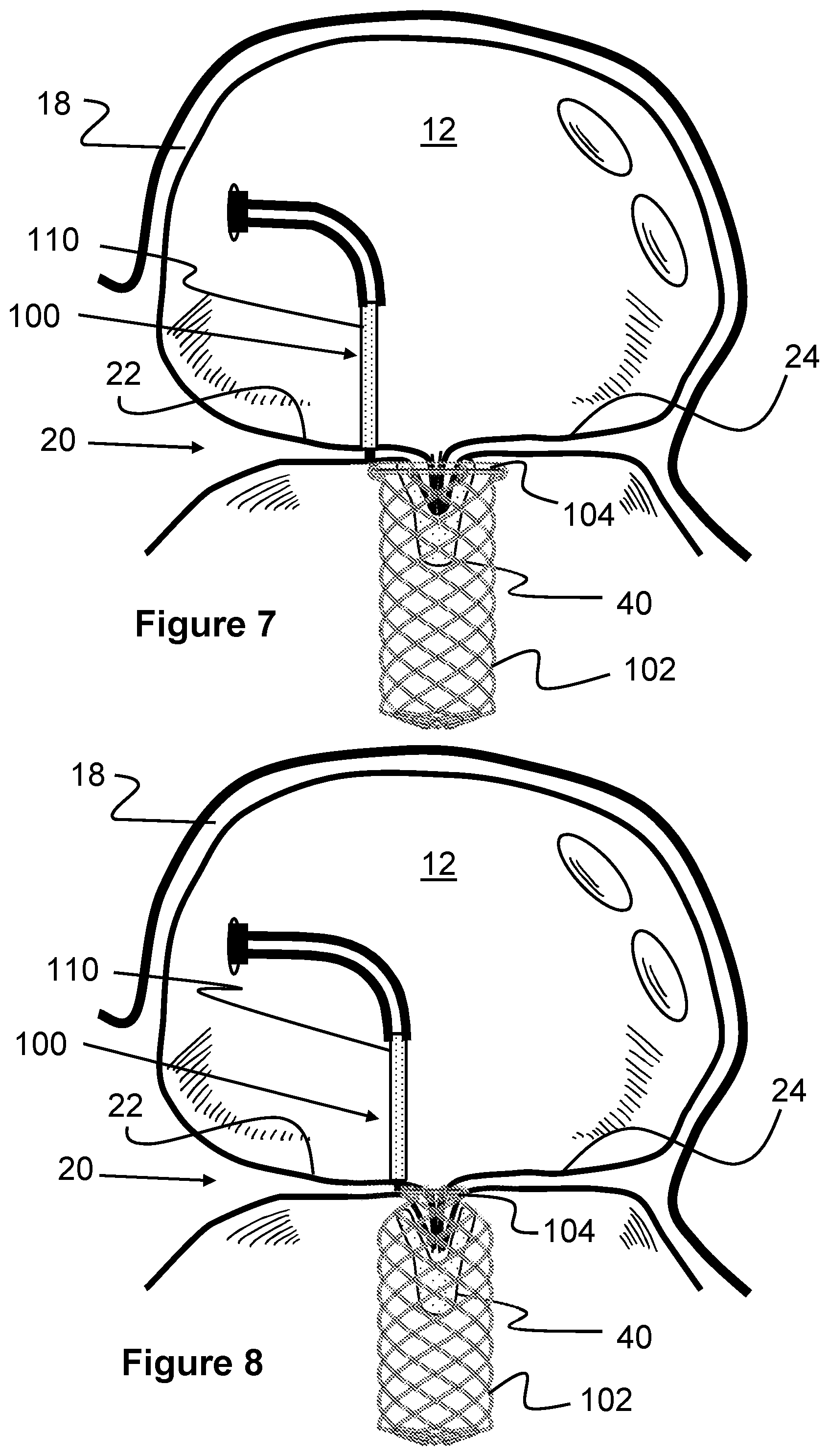 Patent US12569274 Figure 5 – Method and apparatus for removing heart valve therapy