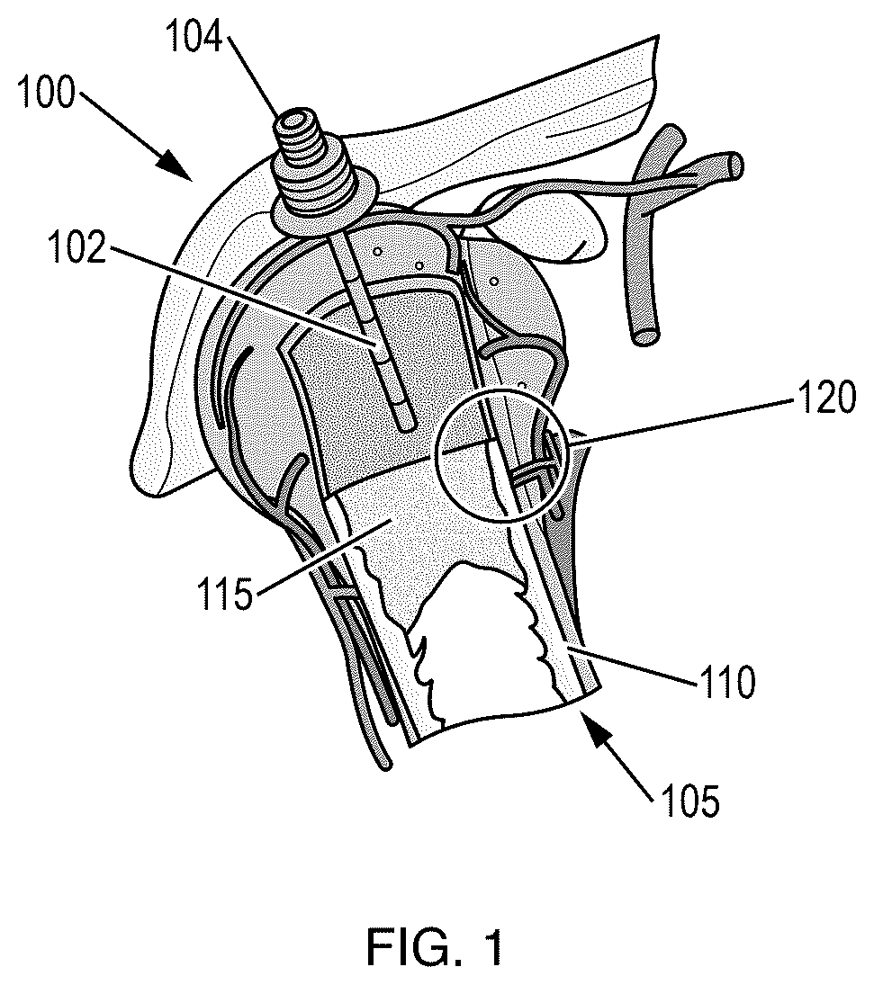 Patent US12569277 — Intraosseous catheter placement confirmation device and method — Figure 1
