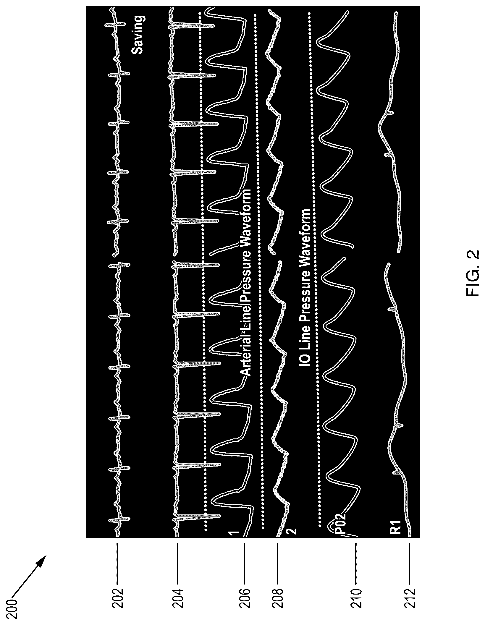 Patent US12569277 Figure 2 – Intraosseous catheter placement confirmation device and method