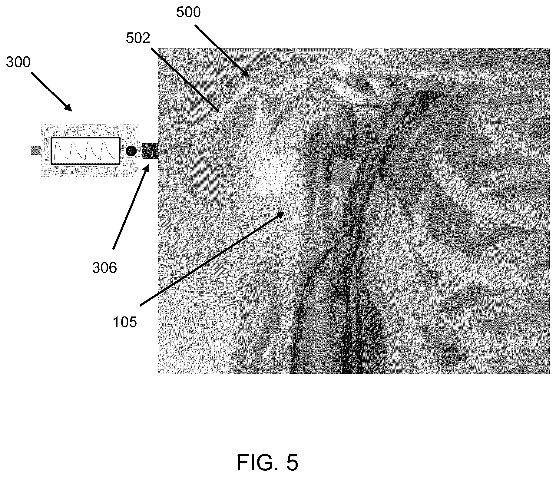 Patent US12569277 Figure 5 – Intraosseous catheter placement confirmation device and method