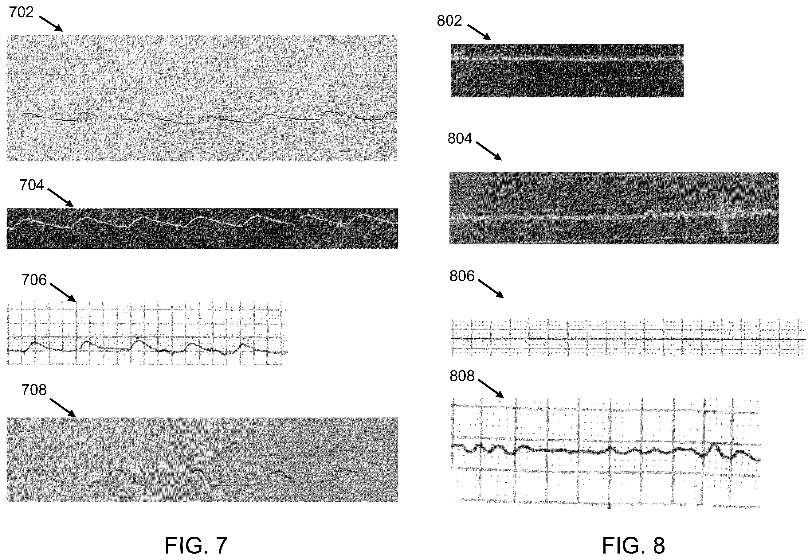Patent US12569277 Figure 7 – Intraosseous catheter placement confirmation device and method
