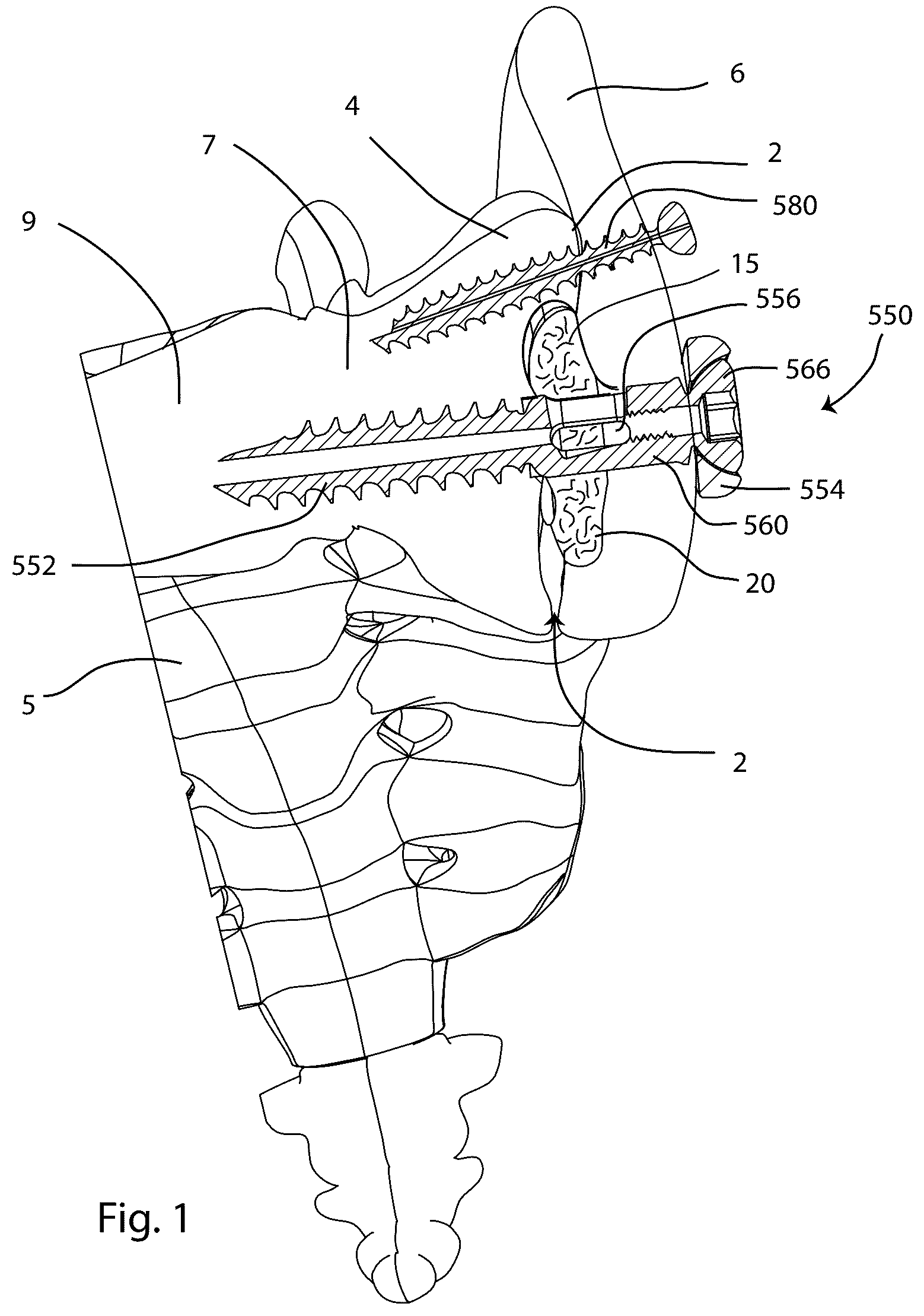 Patent US12569280 Figure 1 – Joint fusion implant and methods