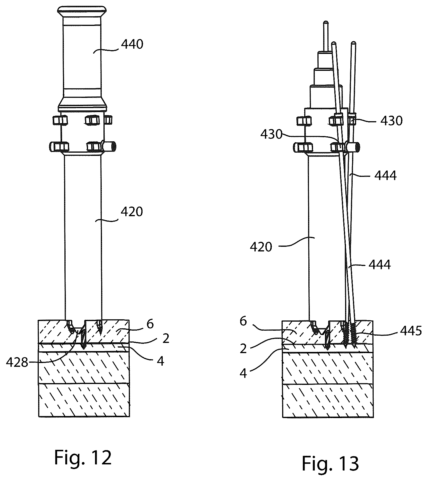 Patent US12569280 Figure 10 – Joint fusion implant and methods