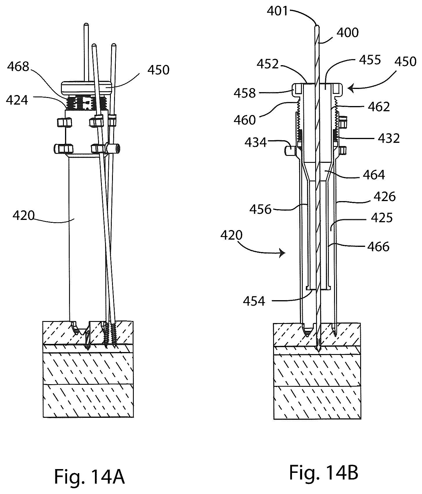Patent US12569280 Figure 11 – Joint fusion implant and methods