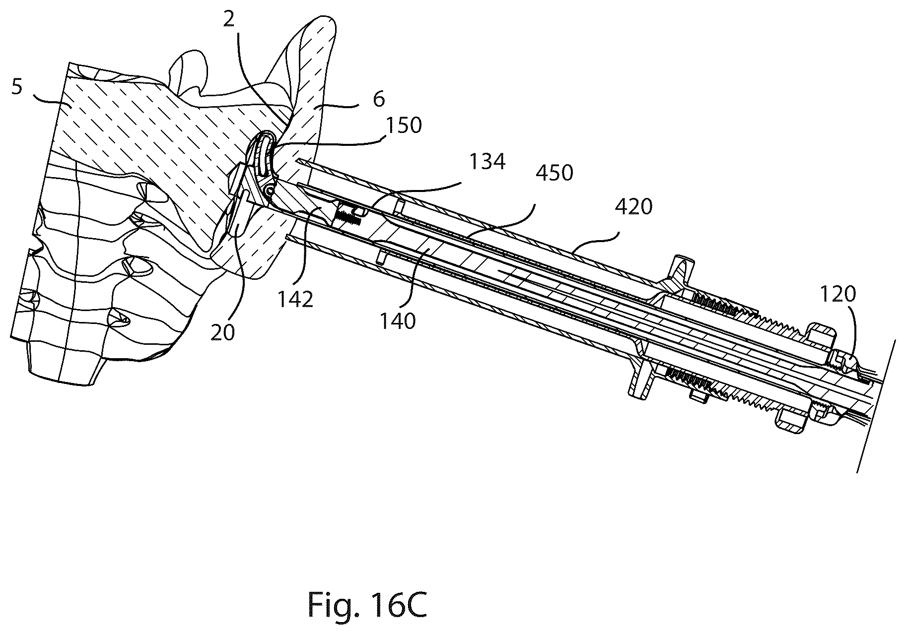 Patent US12569280 Figure 14 – Joint fusion implant and methods