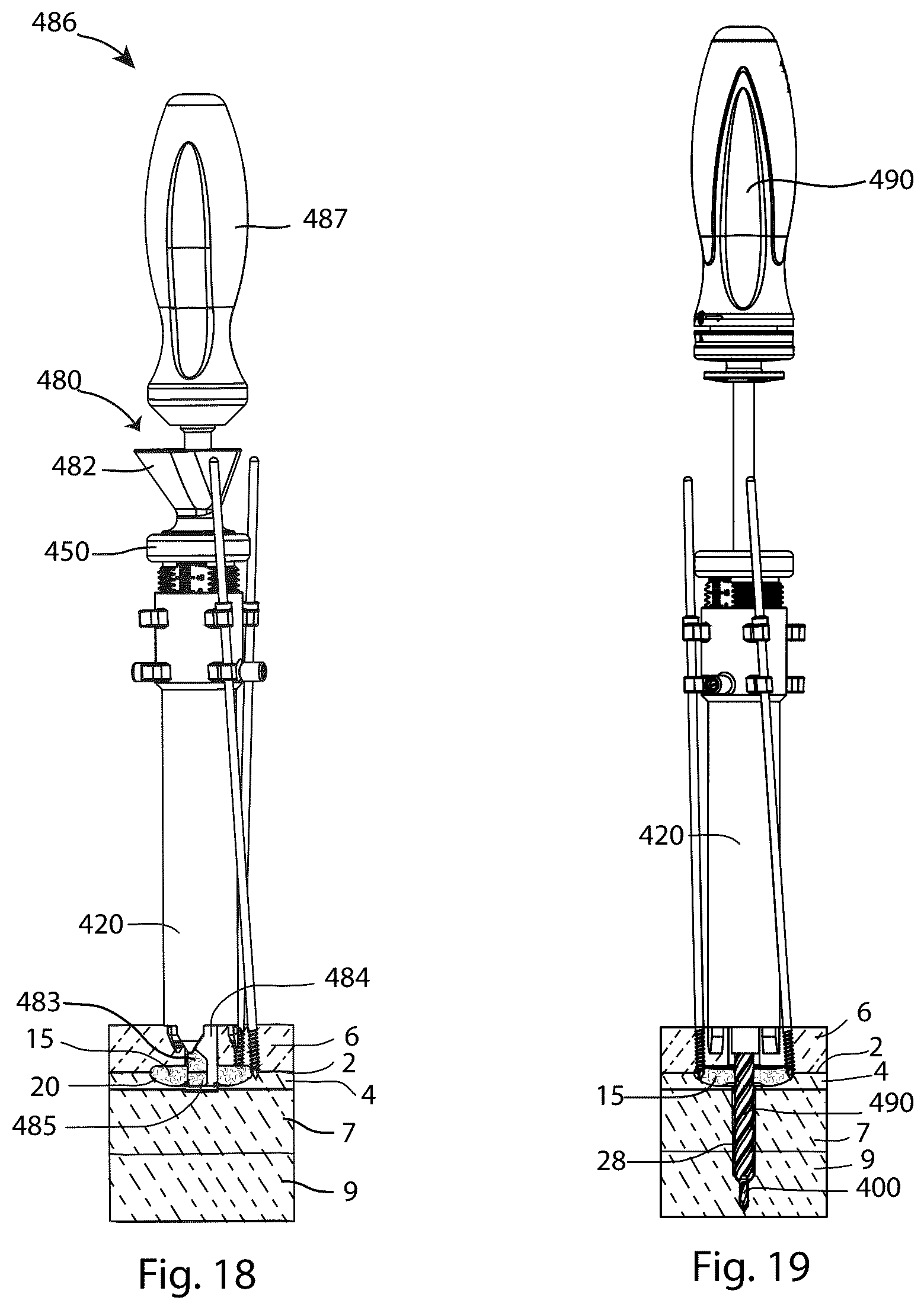 Patent US12569280 Figure 15 – Joint fusion implant and methods