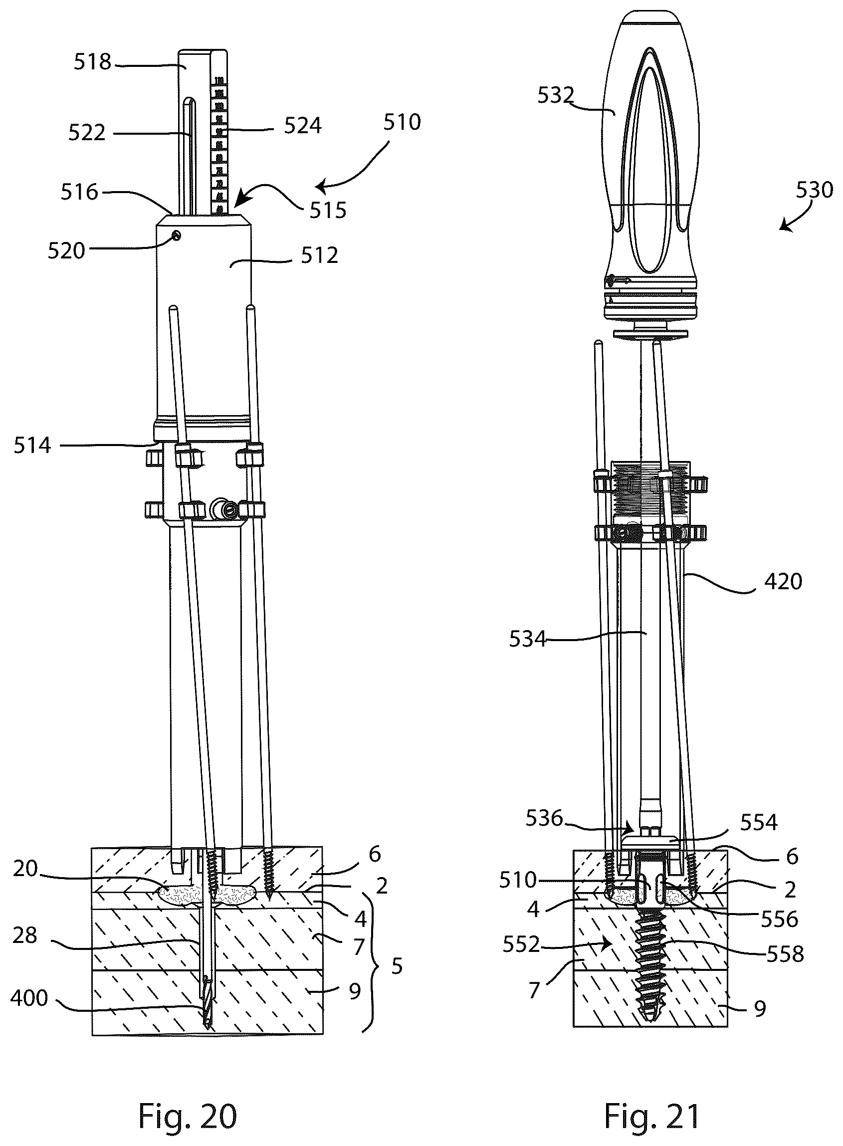 Patent US12569280 Figure 16 – Joint fusion implant and methods