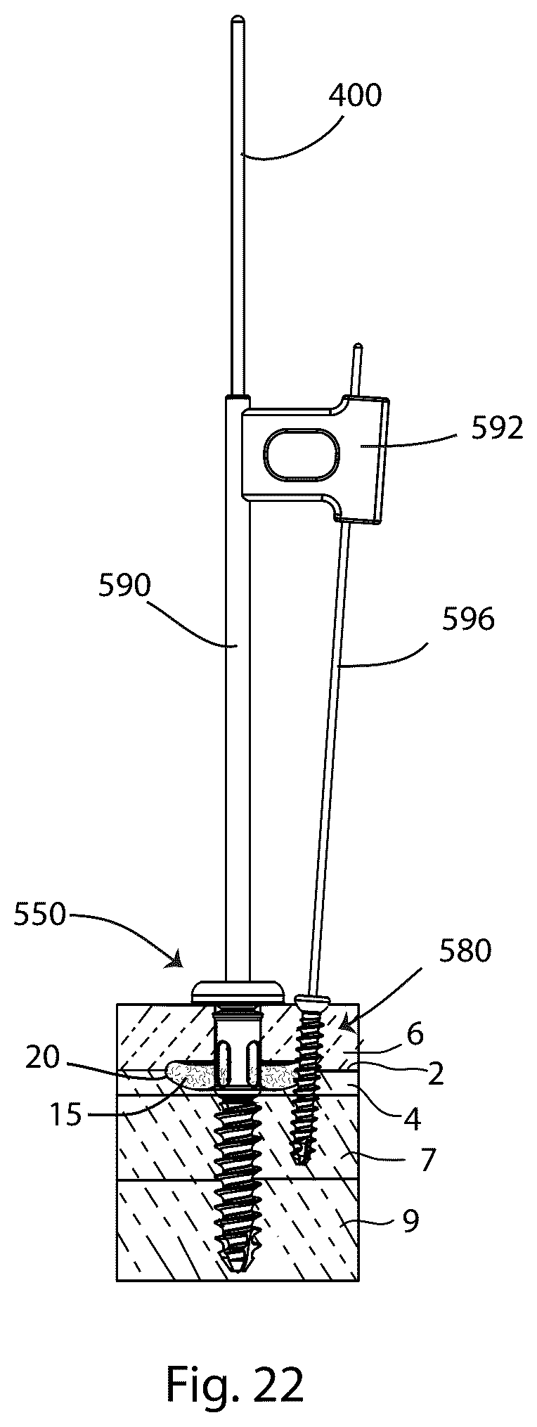 Patent US12569280 Figure 17 – Joint fusion implant and methods