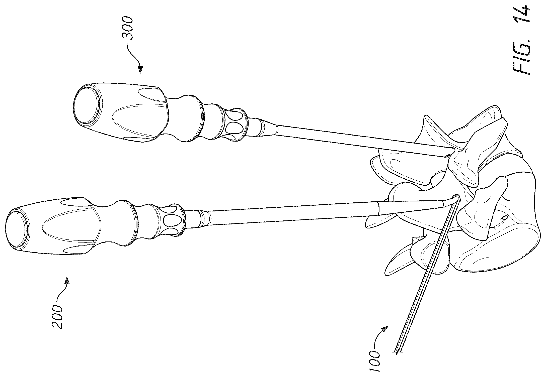 Patent US12569281 Figure 14 – Bone tie and bone tie inserter