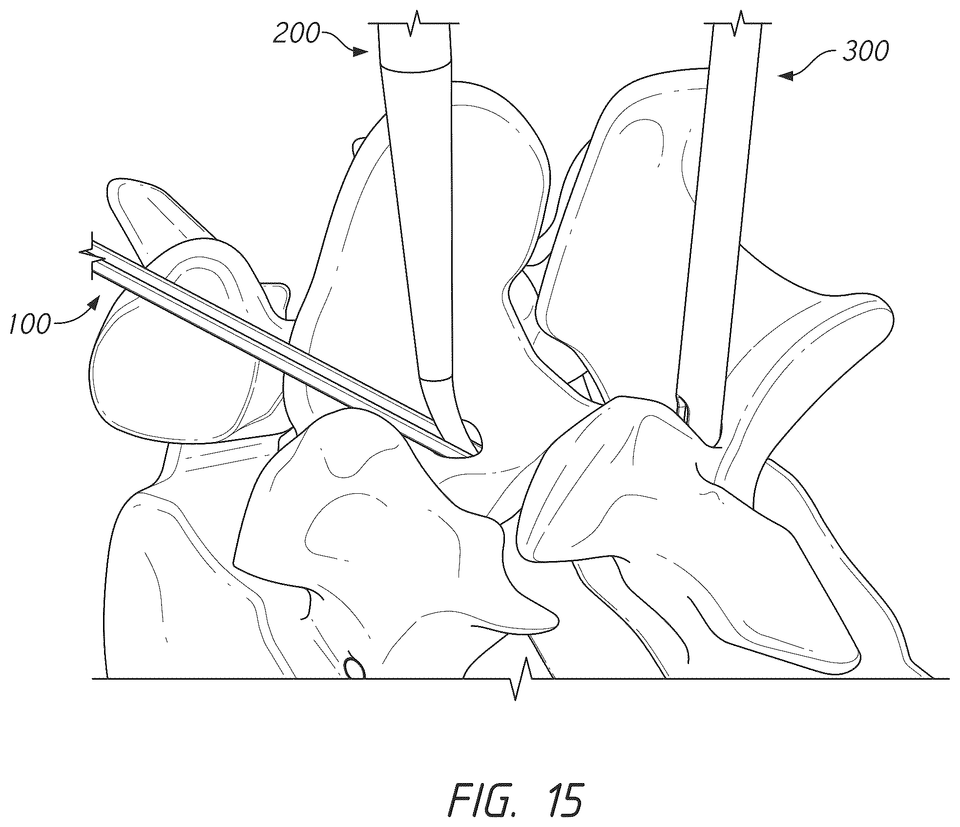 Patent US12569281 Figure 15 – Bone tie and bone tie inserter