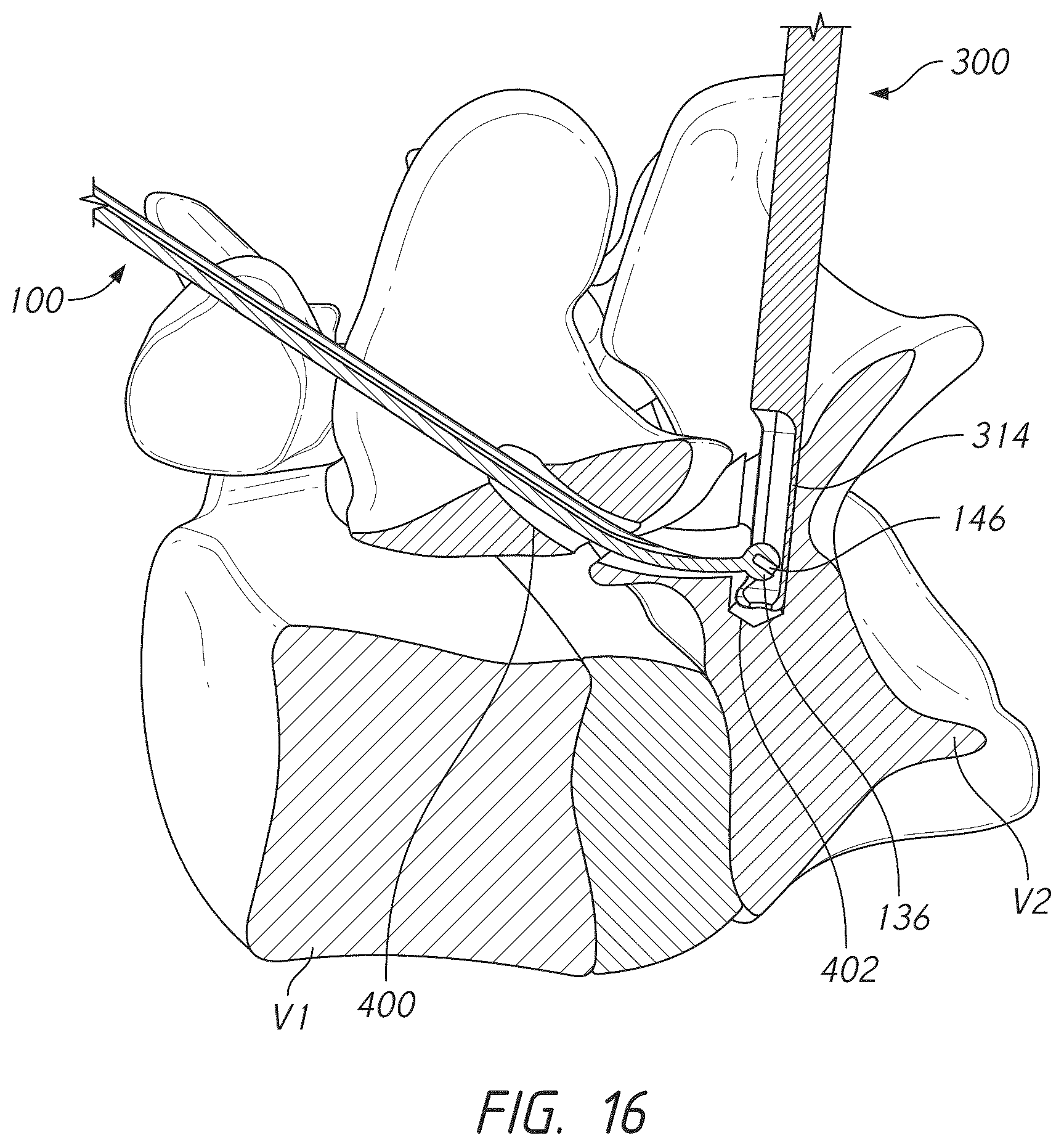 Patent US12569281 Figure 16 – Bone tie and bone tie inserter