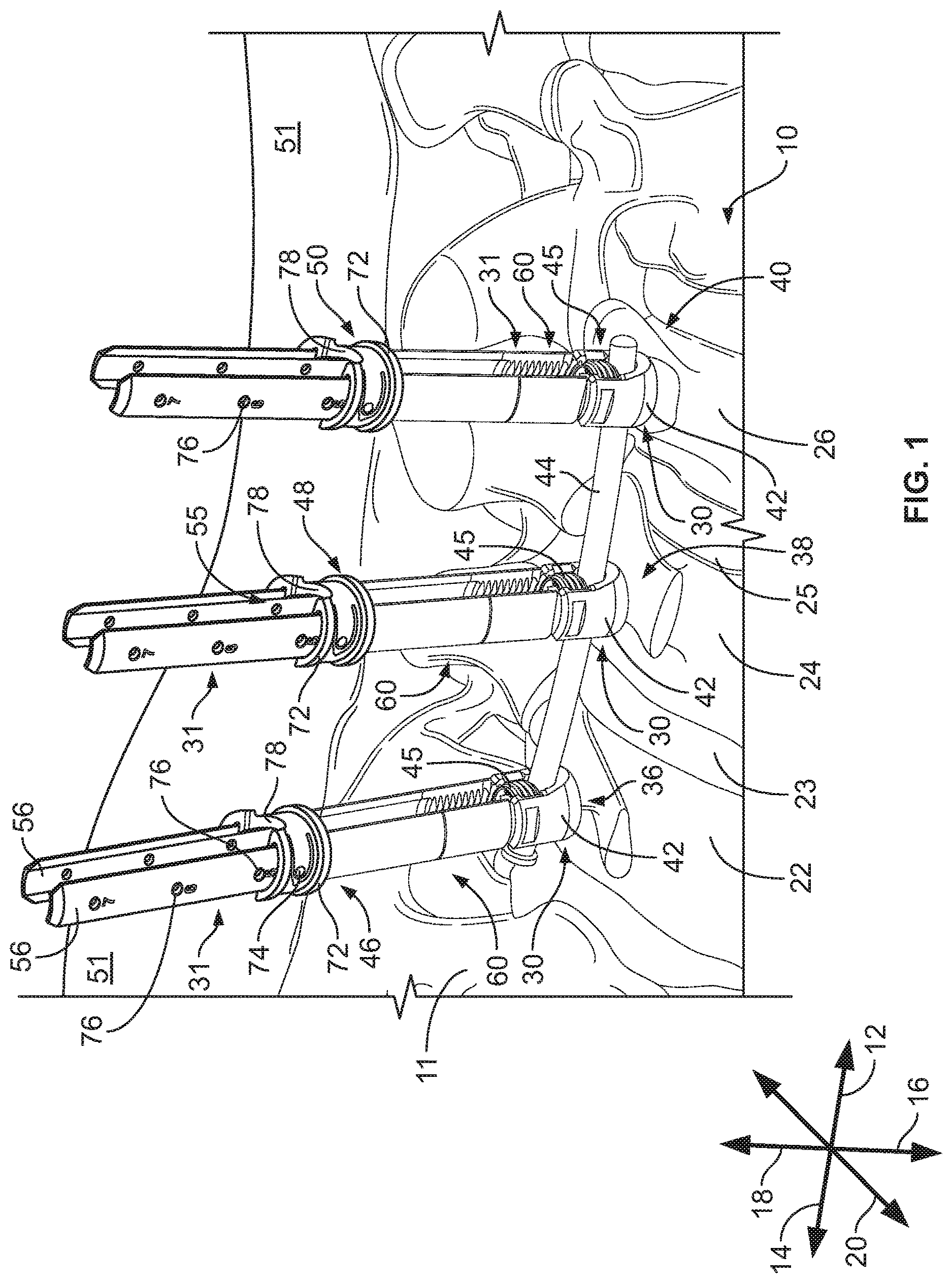 Patent US12569282 Figure 1 – Tissue retraction and vertebral displacement devices, systems, and methods for posterior spinal fusion