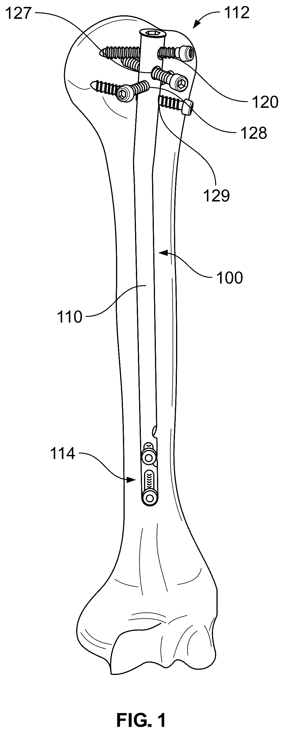 Patent US12569284 Figure 1 – Screw hole adapted for different screws