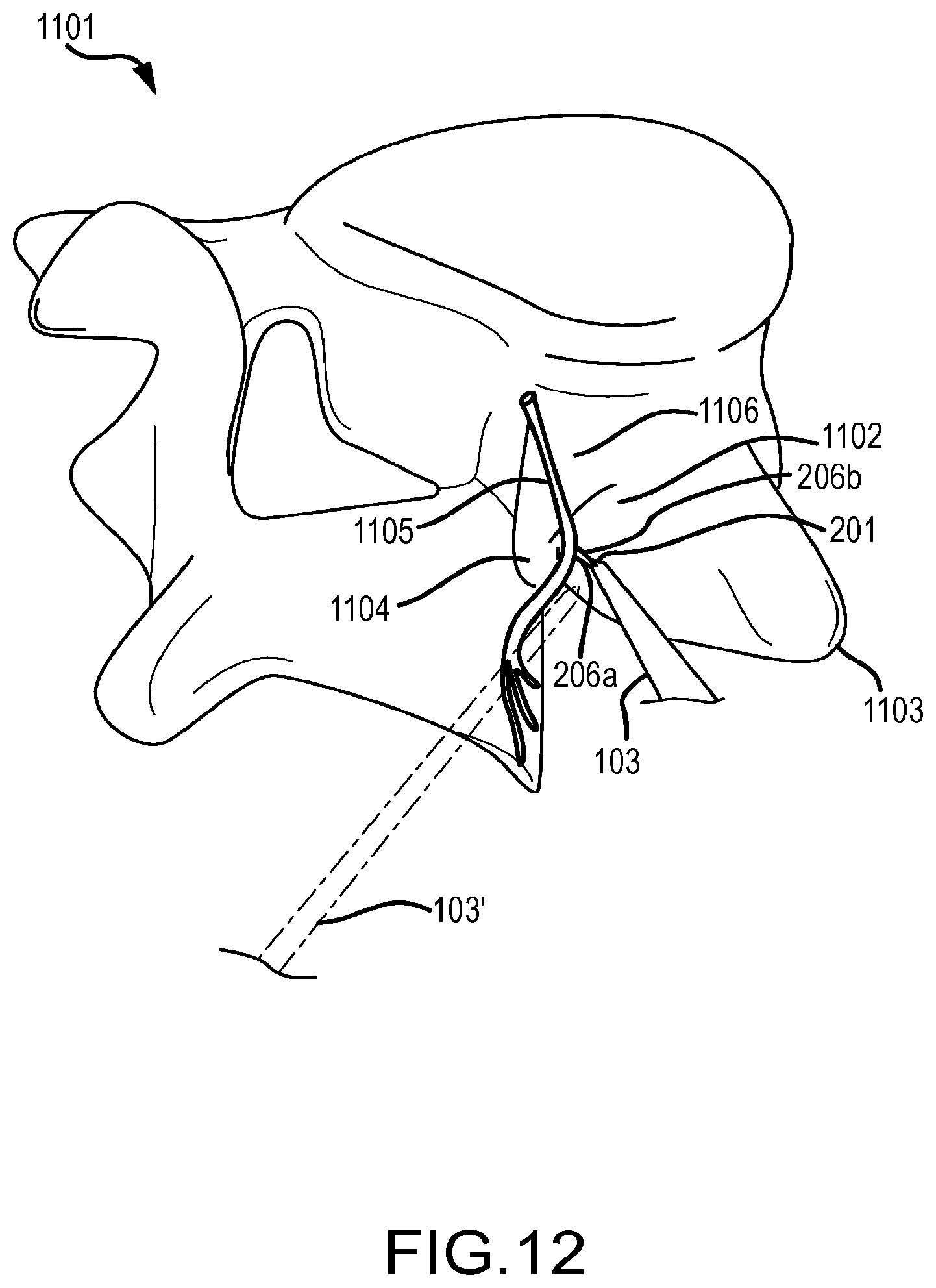 Patent US12569293 Figure 16 – Systems for radiofrequency neurotomy