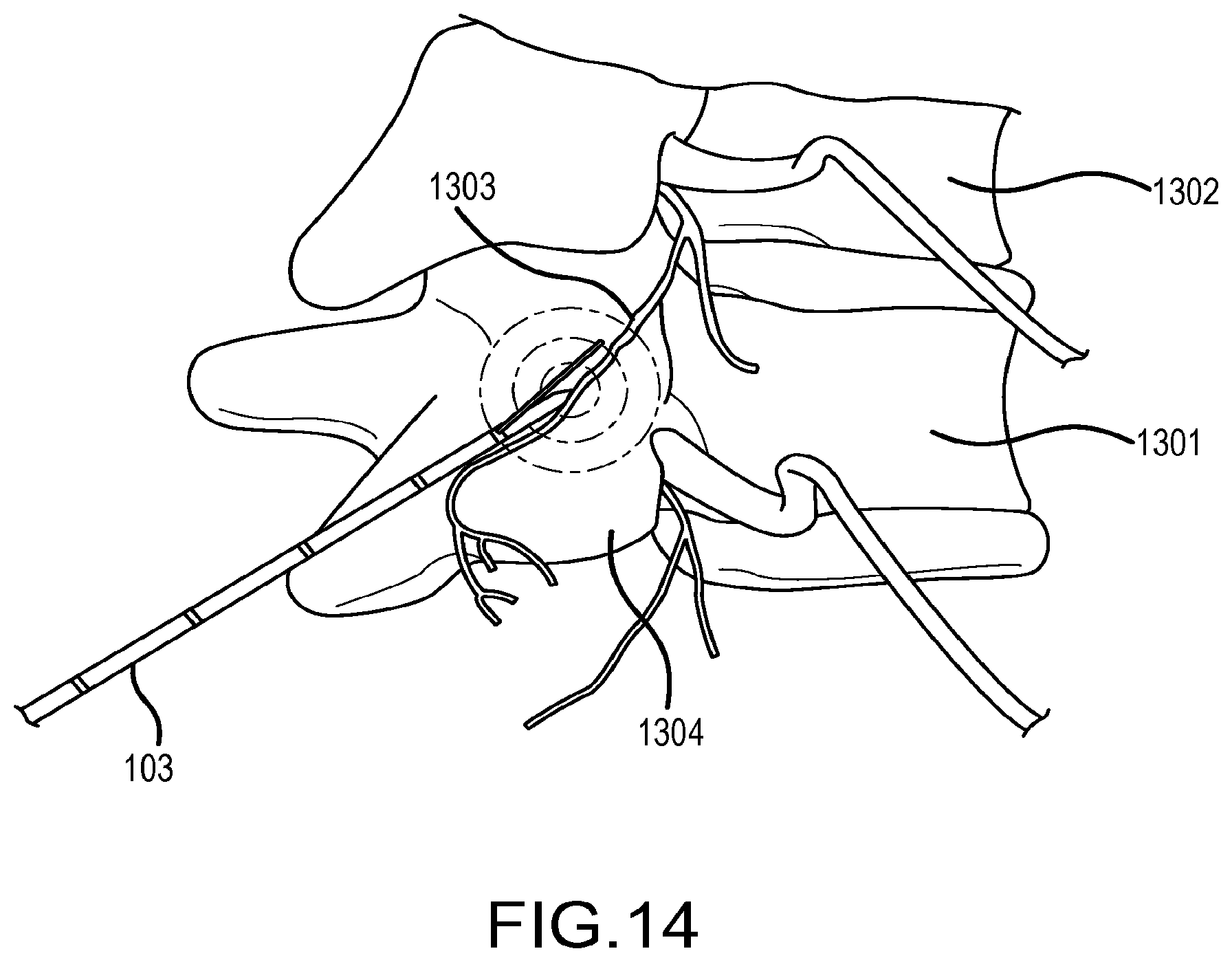 Patent US12569293 Figure 18 – Systems for radiofrequency neurotomy