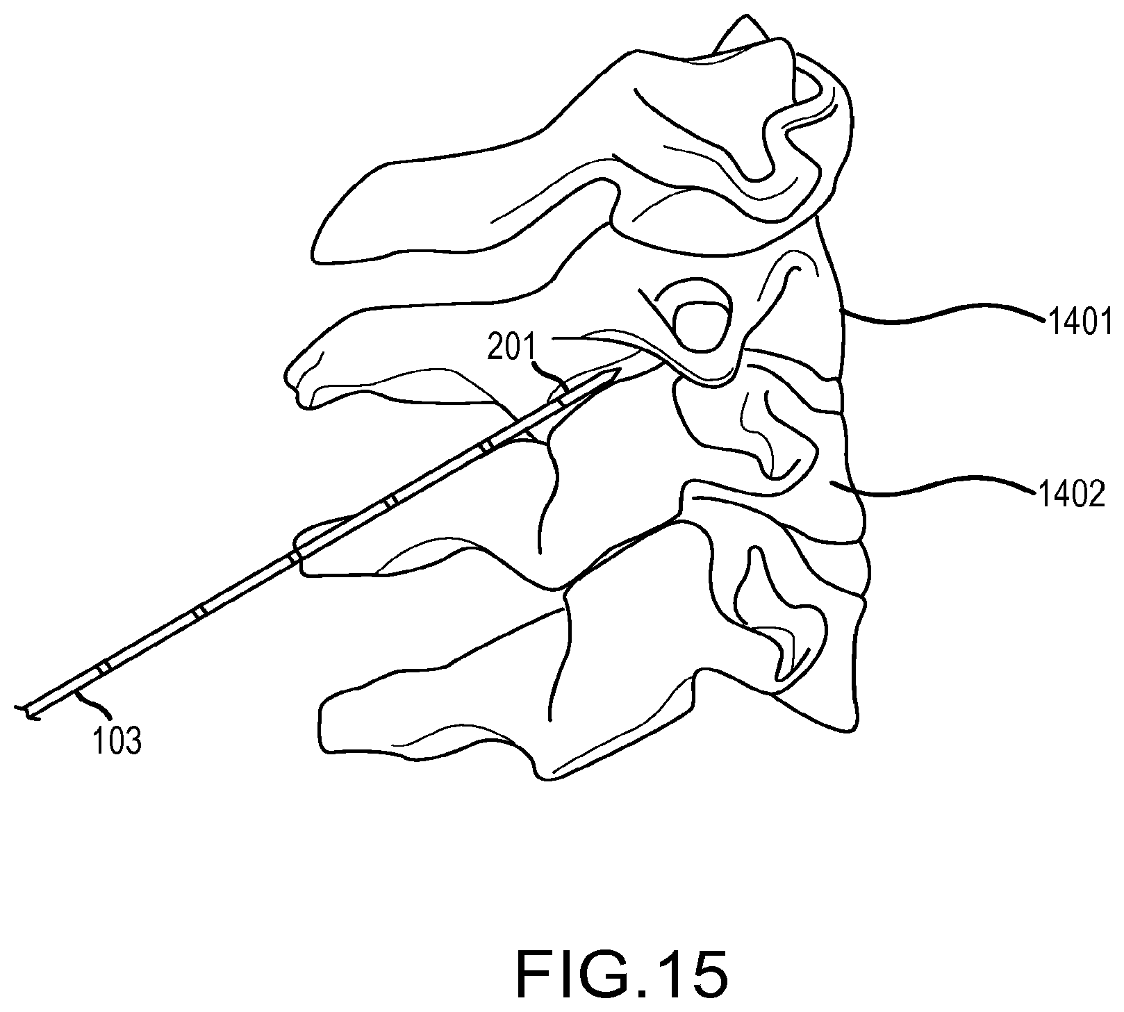 Patent US12569293 Figure 19 – Systems for radiofrequency neurotomy
