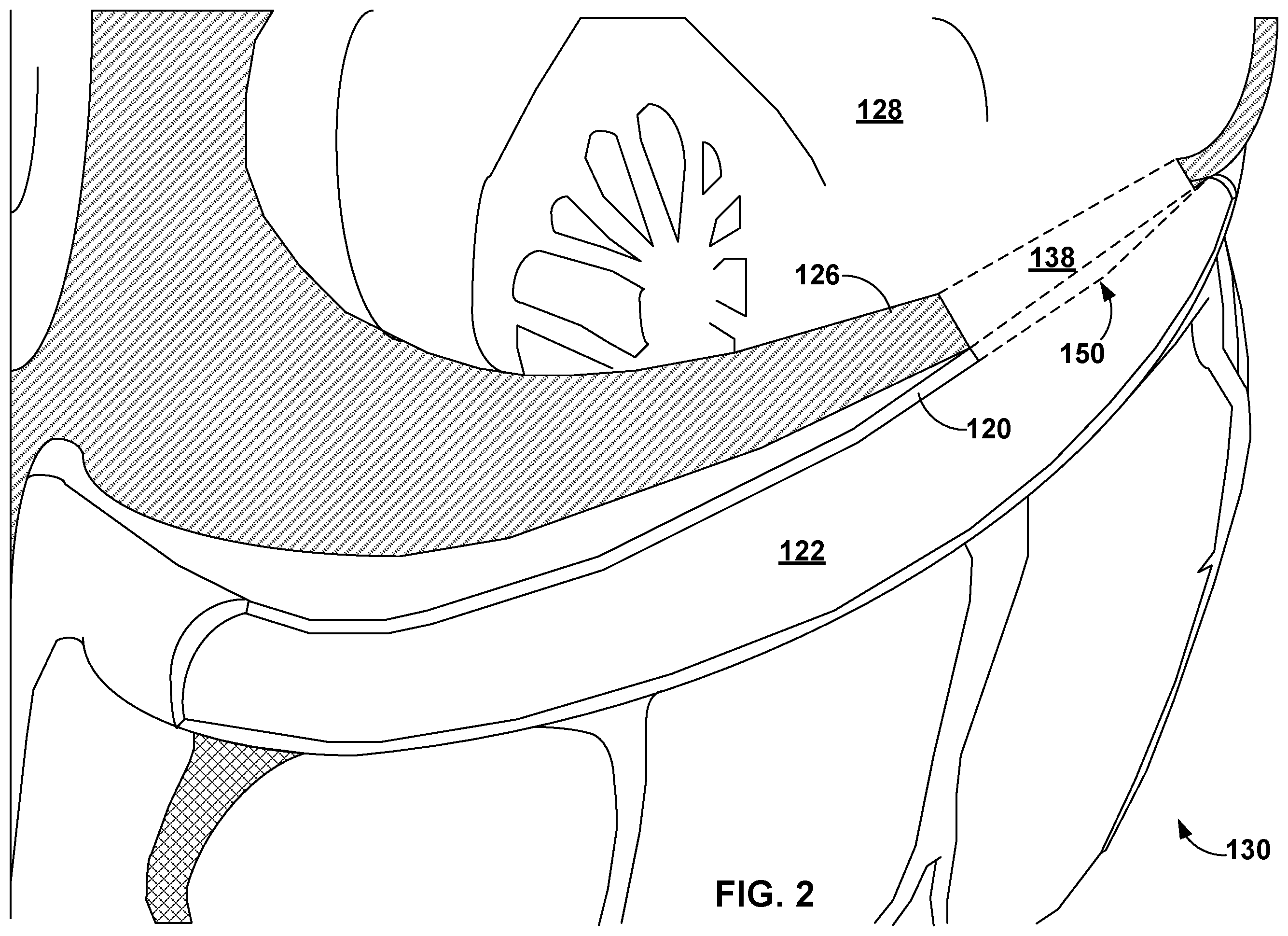 Patent US12569296 Figure 2 – Left-atrium-to-coronary-sinus shunt