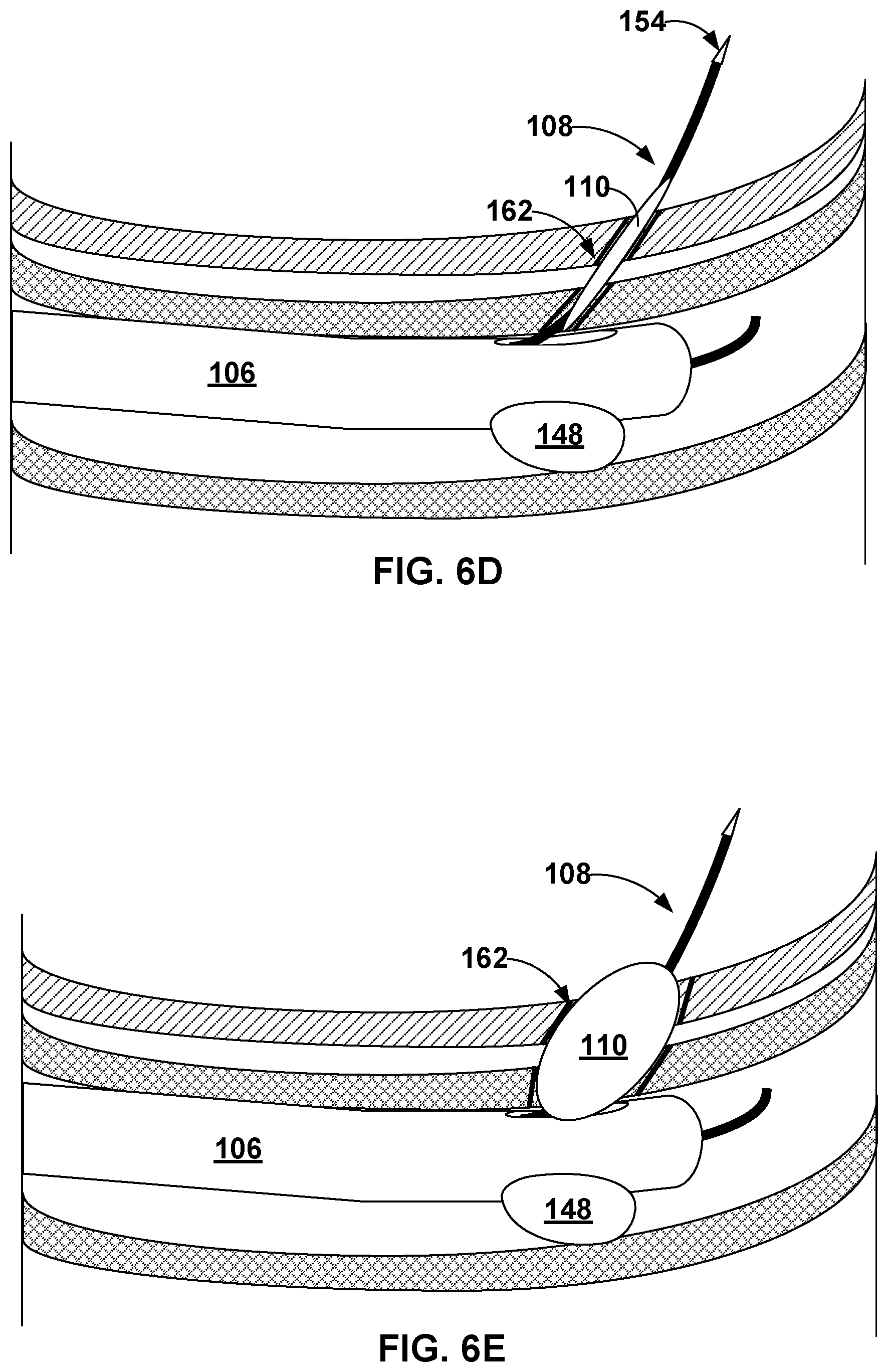 Patent US12569296 Figure 7 – Left-atrium-to-coronary-sinus shunt