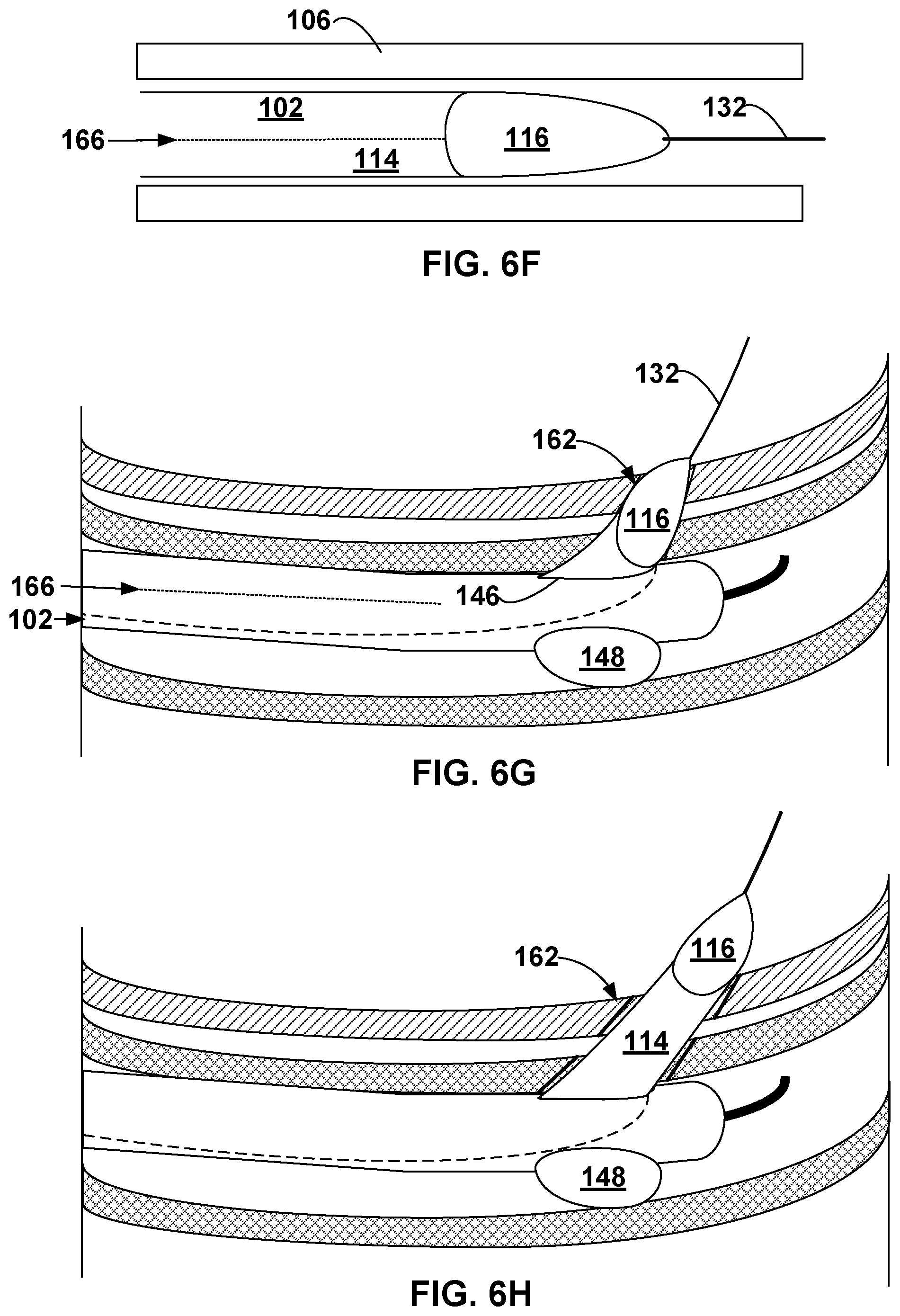 Patent US12569296 Figure 8 – Left-atrium-to-coronary-sinus shunt