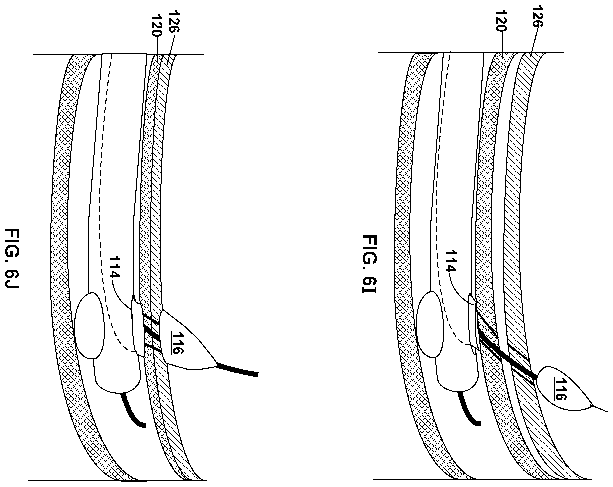 Patent US12569296 Figure 9 – Left-atrium-to-coronary-sinus shunt