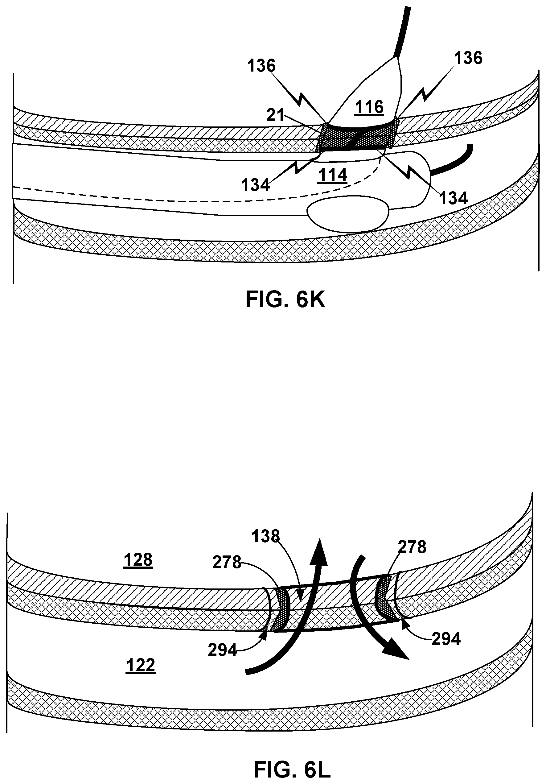 Patent US12569296 Figure 10 – Left-atrium-to-coronary-sinus shunt
