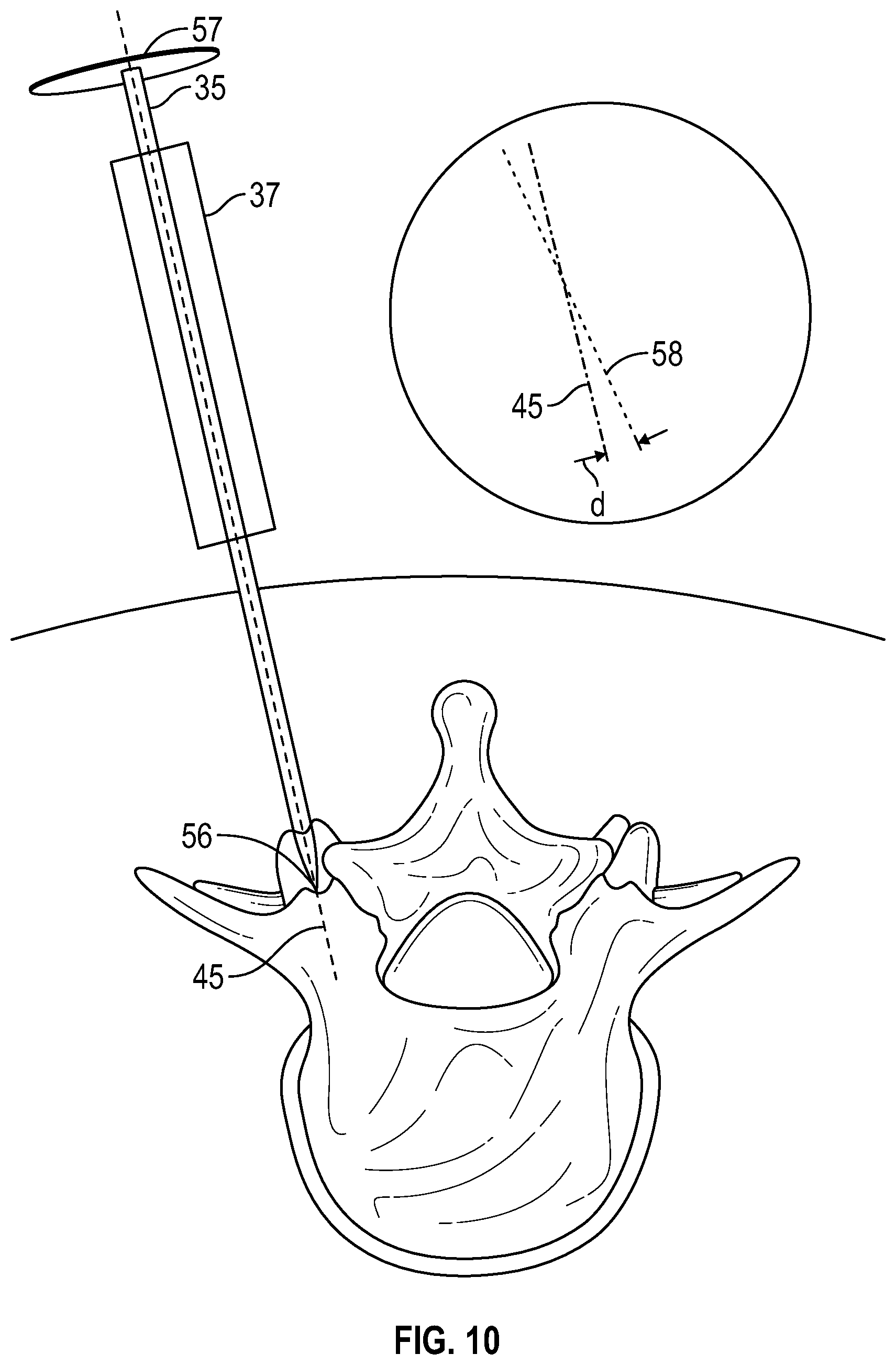 Patent US12569301 Figure 13 – Surgical navigation system for alignment of a surgical instrument