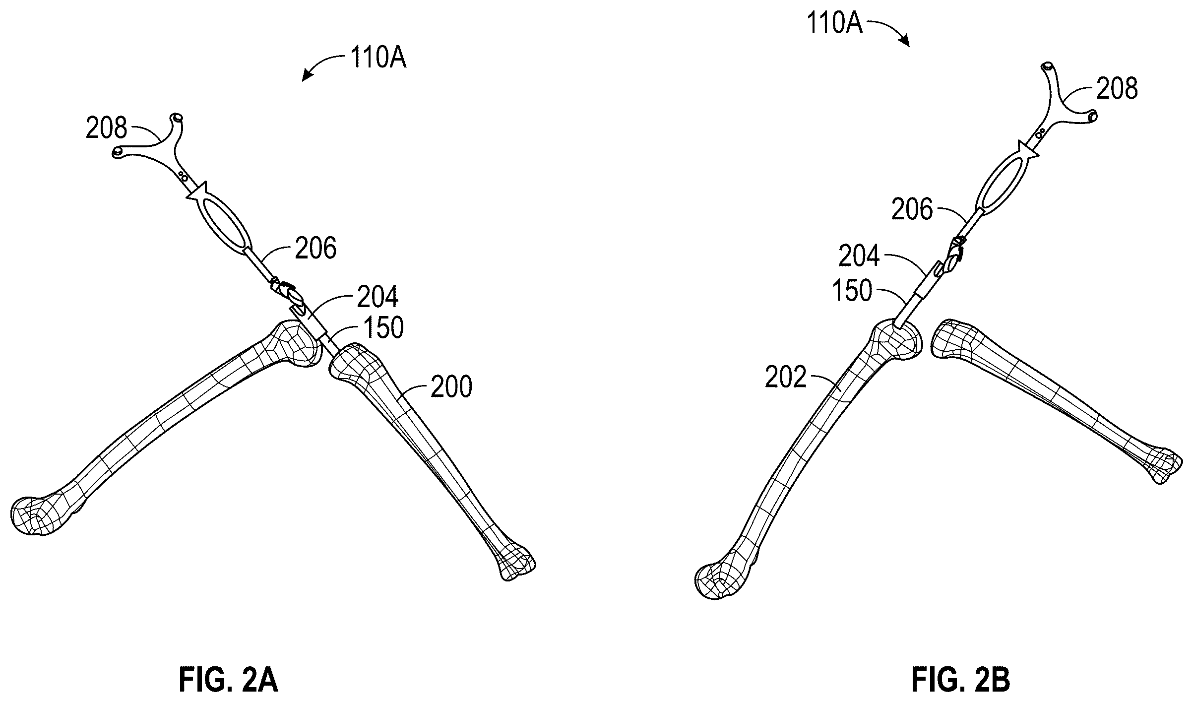 Patent US12569306 Figure 2 – Robotic revision knee arthroplasty virtual reconstruction system