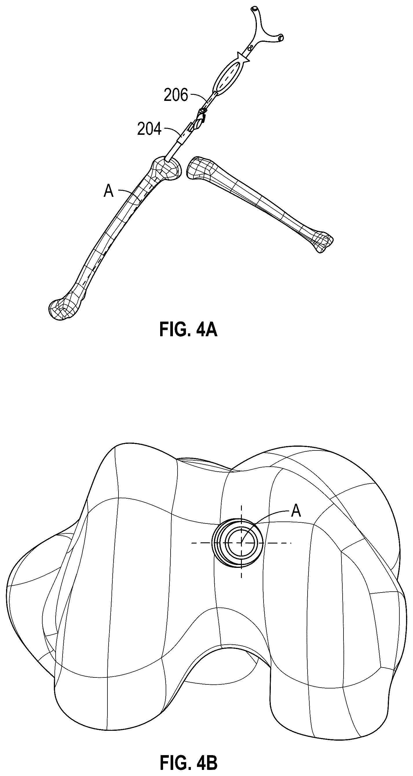 Patent US12569306 Figure 4 – Robotic revision knee arthroplasty virtual reconstruction system