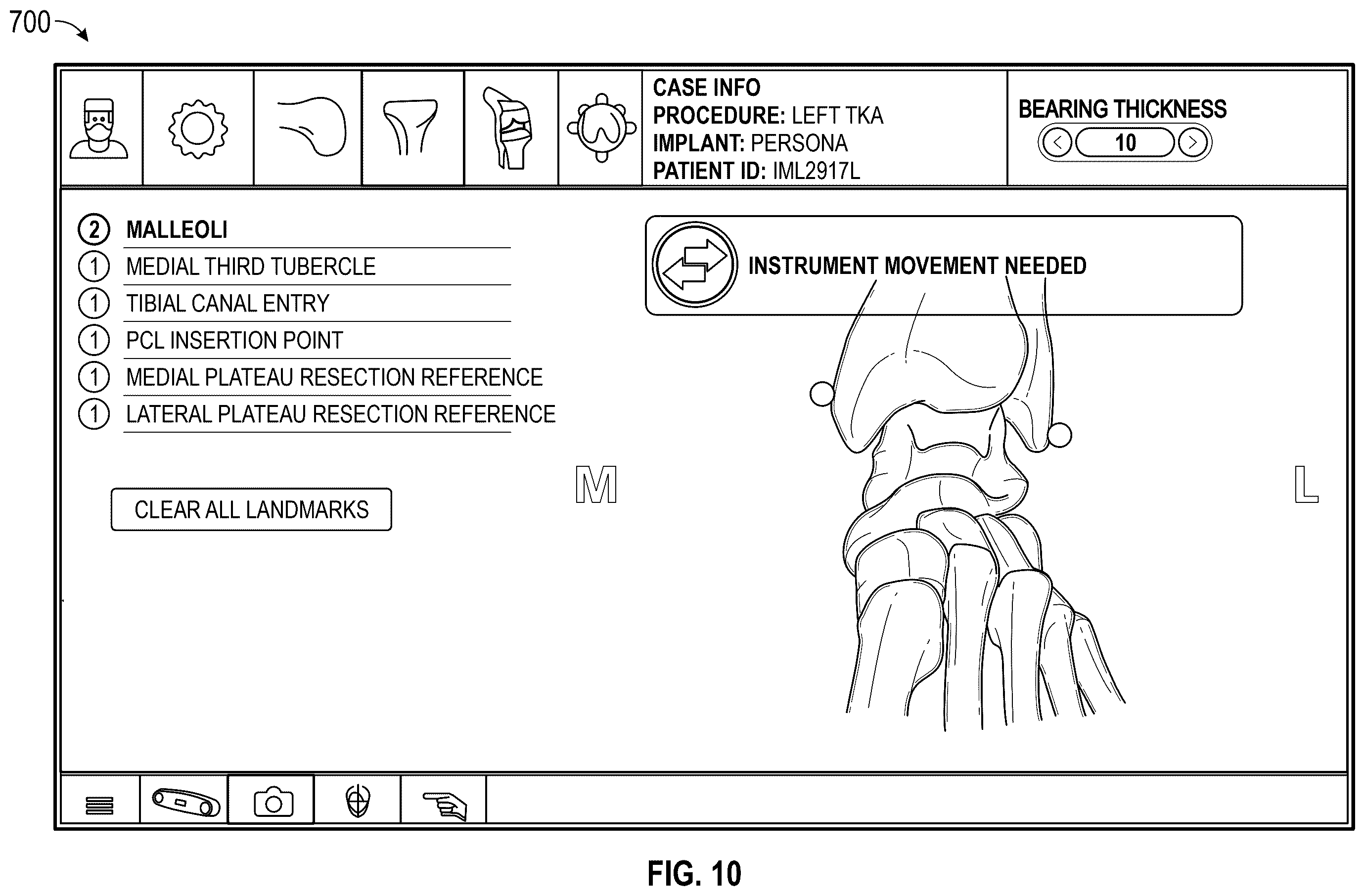 Patent US12569306 Figure 11 – Robotic revision knee arthroplasty virtual reconstruction system