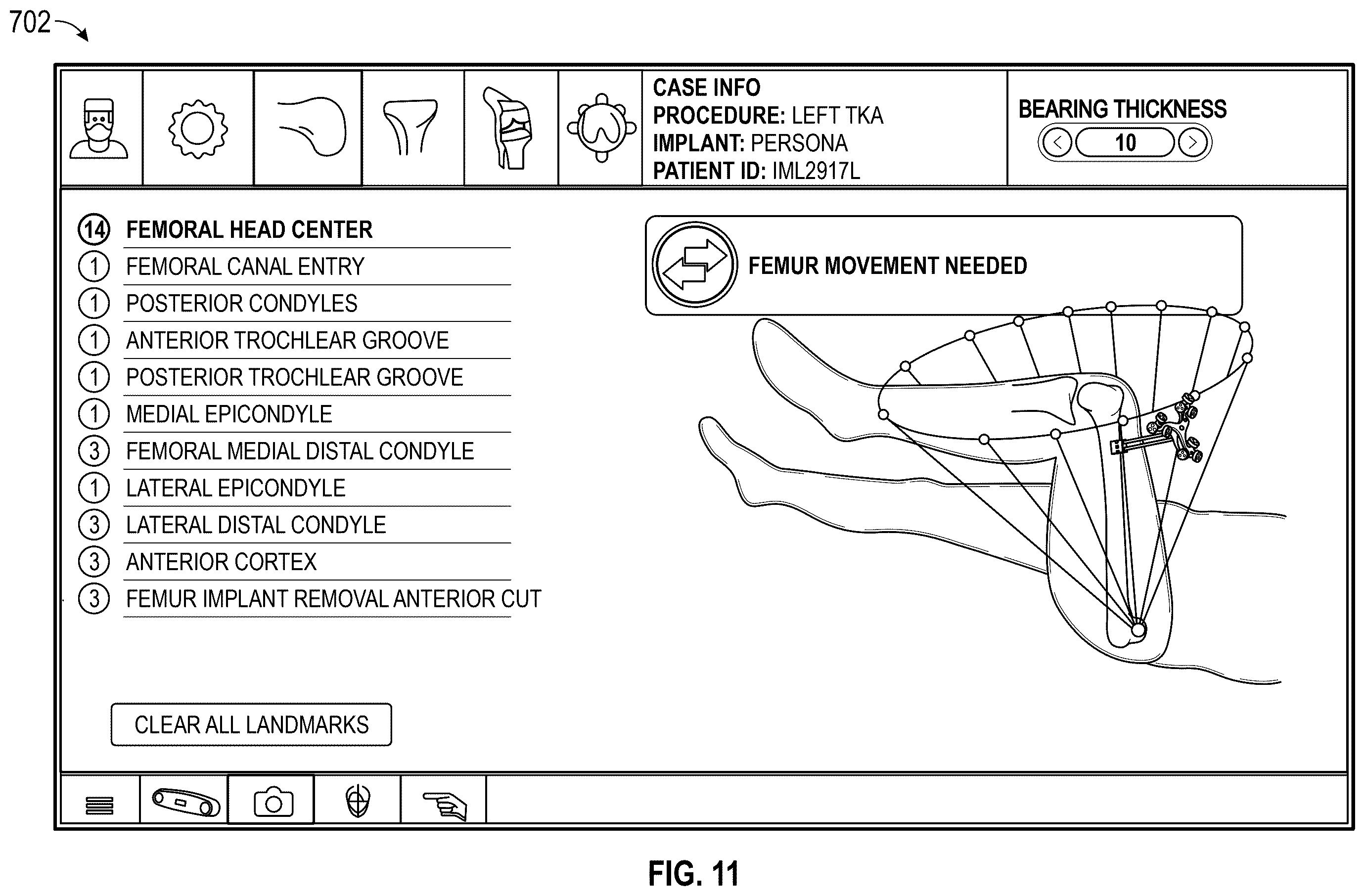 Patent US12569306 Figure 12 – Robotic revision knee arthroplasty virtual reconstruction system