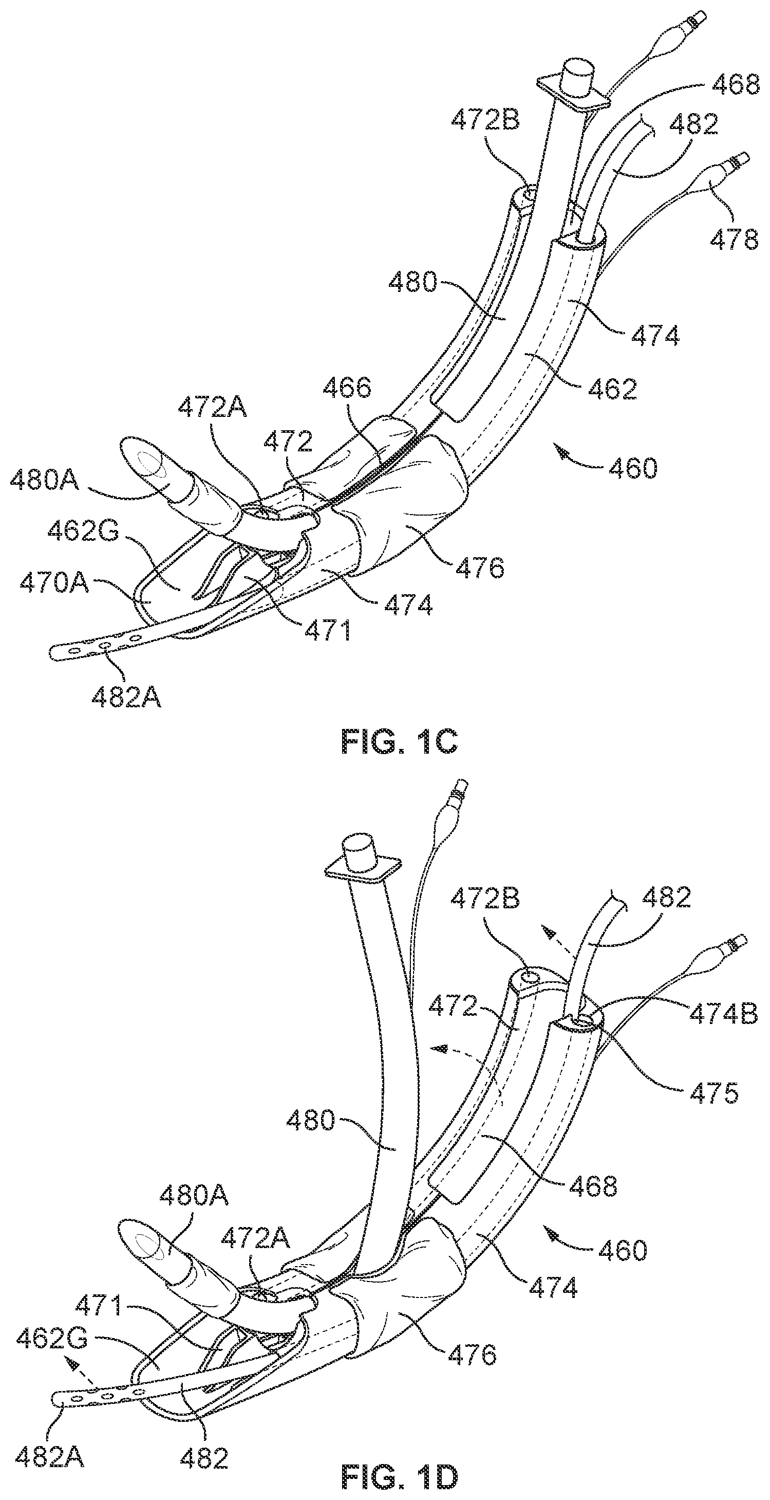 Patent US12569314 Figure 2 – Medical devices for airway management and methods of placement