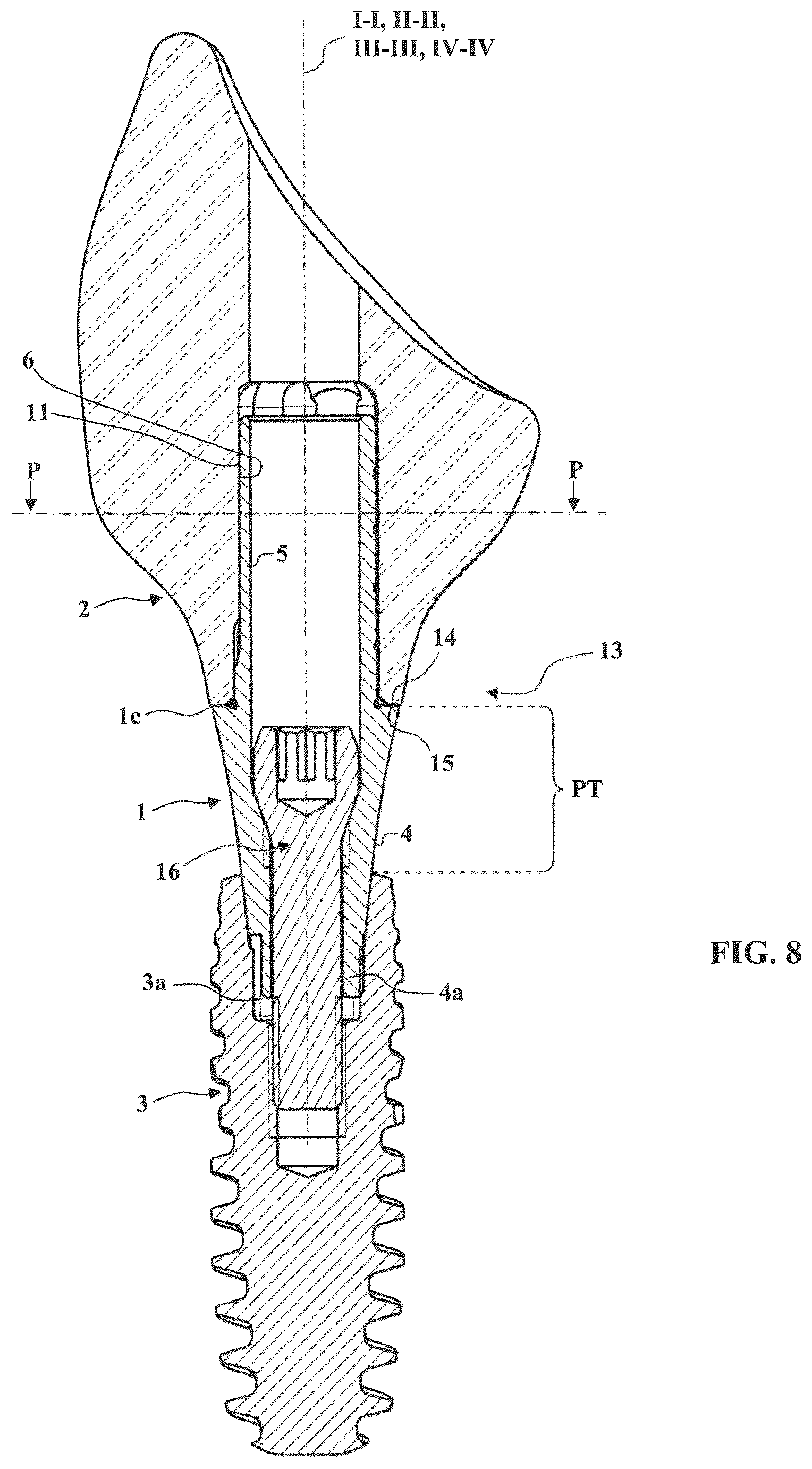 Patent US12569320 Figure 5 – Method for manufacturing an abutment for receiving a dental prosthesis